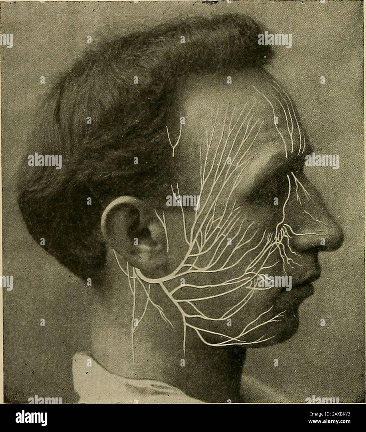 Anatomie appliquée et chirurgie orale pour les étudiants dentaires . temporal. Masseteric. Pterygoid.1^ Buccal externe. Auriculotemporal. Langue. C Mylohyoïde. Dentaire inférieure. < Dental.(, Mental. Le septième Nerf Le septième nerf crânien ou facial (Fig. 2 2) est le nerf moteur des muscles de l'expression du visage, et alsofournit le cuir chevelu, l'oreille externe, les myoides de platysma, le bucina-tor, le ventre postérieur des muscles digastriques et stylohyoïdes. L'origine profonde du nerf facial se trouve dans le sol du quatrième ventricule. Son origine superficielle provient du médicament ulla, entre l'olivaire et le bo restiforme Banque D'Images Anatomie appliquée et chirurgie orale pour les étudiants dentaires . temporal. Masseteric. Pterygoid.1^ Buccal externe. Auriculotemporal. Langue. C Mylohyoïde. Dentaire inférieure. < Dental.(, Mental. Le septième Nerf Le septième nerf crânien ou facial (Fig. 2 2) est le nerf moteur des muscles de l'expression du visage, et alsofournit le cuir chevelu, l'oreille externe, les myoides de platysma, le bucina-tor, le ventre postérieur des muscles digastriques et stylohyoïdes. L'origine profonde du nerf facial se trouve dans le sol du quatrième ventricule. Son origine superficielle provient du médicament ulla, entre l'olivaire et le bo restiforme Banque D'Images