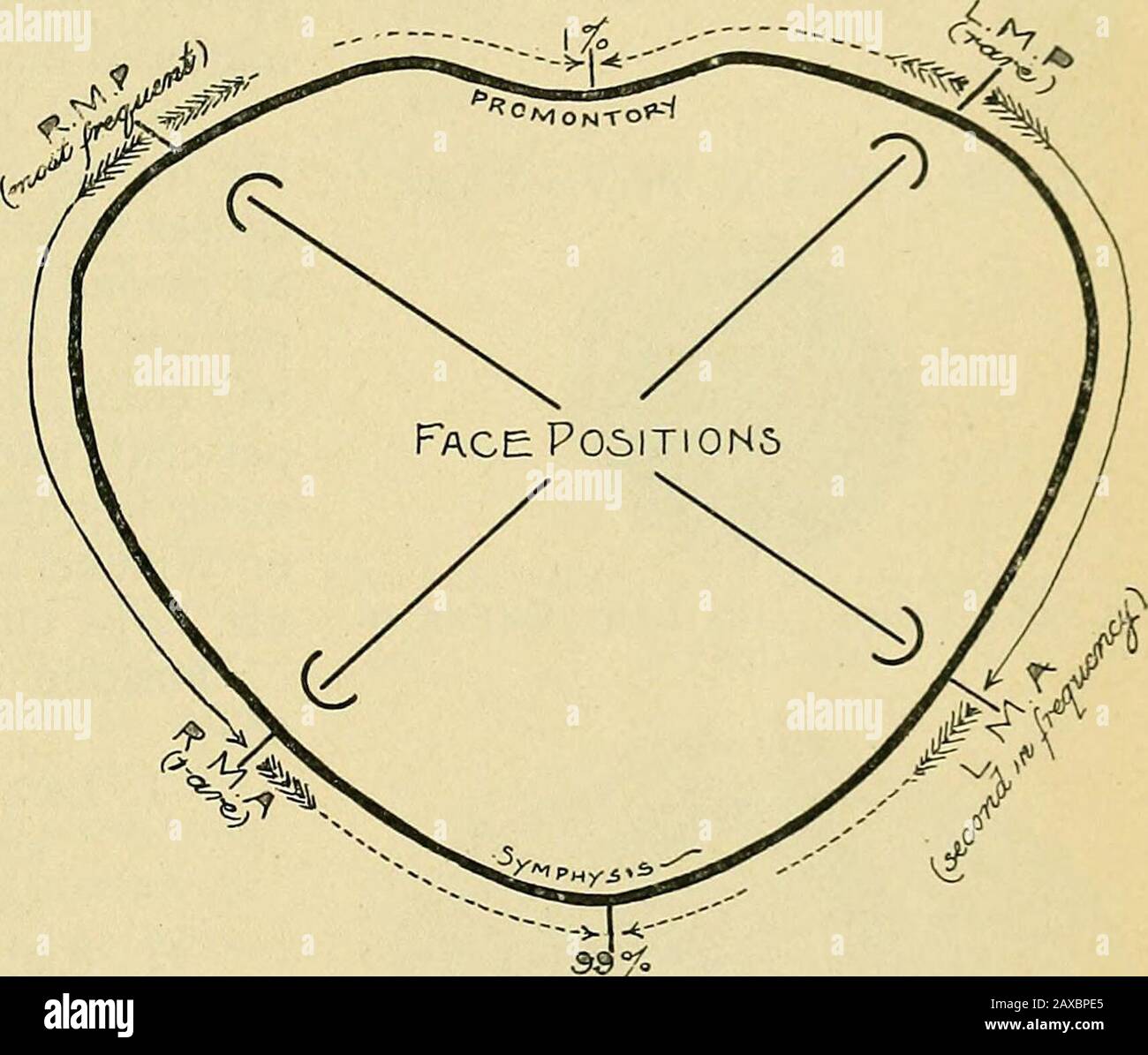 La pratique de l'obstétrique, conçue pour l'utilisation des étudiants et des praticiens de la médecine . rematurité, contractedpelvis, hydramnios, grossesse multiple, monstrosités, etc. Ces, cependant, ne peuvent pas être mis en relation directe avec les effets produits, et le lien entre les deux est une question de statistiques plutôt que de démonstration ofactuelle. Il est évident que nous devons regarder encore plus deeplyinto la matière avant de pouvoir épuiser tous les facteurs étiologiques possibles. L'élément onlyone reste à prendre en considération, c'est-à-dire l'utérus lui-même. Matthews Duncanwas a pu tracer une relation entre lat Banque D'Images