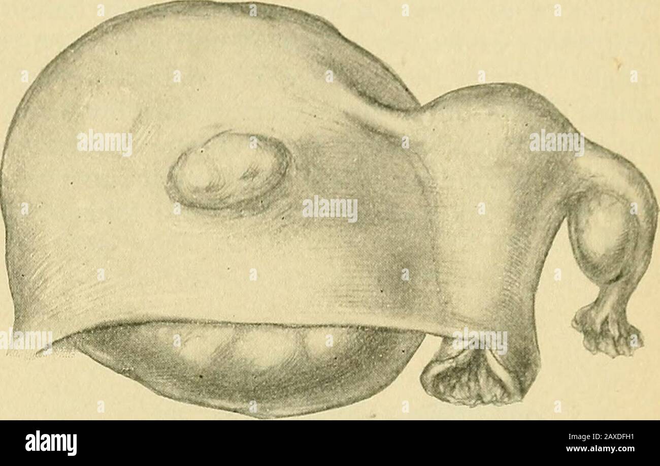 La pratique de l'obstétrique, conçue pour l'utilisation des étudiants et des praticiens de la médecine . Fig. 491. — grossesse interstitielle.paroi Droite De L'Utérus. FourthMonth.—{Bumm.) GROSSESSE EXTRA-UTÉRINE. 363. Fig. 492.—grossesse intrintragentaire.Ligament Large.—{Bumm.) gauche a généralement déclaré que dans tous ces cas, la mort de l'ovule peut être suivie d'une suppuration, mais il est difficile de comprendre comment cela pourrait se produire dans des conditions stériles thenormiques qui devraient être obtenues. Si le fœtus ne meurt qu'après avoir atteint un stade avancé de développement, certains changements noteexceptionnellement après l'intraut Banque D'Images