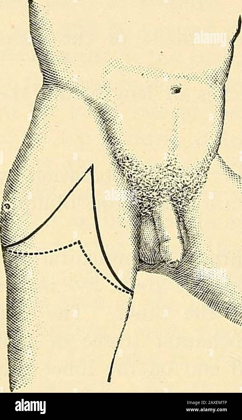 Un manuel de chirurgie opératoire . er Méthodes de Désarticulation.—Des nombreuses autres procédures non décrites ici, il n'est nécessaire que de faire allusion aux* amputations des lambeaux latéraux. Ces opérations sont toujours conseillées par certains chirurgiens en cas de blessure limitée à l'avant de la cuisse, comme dans la blessure par balle, et 2 r 674 AMPUTATIONS [partie VI dans les cas où une croissance se projette vers la partie antérieure du thimb. Il reste des souches très impropres, et ces méthodes n'ont rien de littleor pour les recommander. Fig. 426 affiche les incisions de la méthode Lisfrancs. Les rabats sont apeurés par transfixion, le bec extérieur Banque D'Images