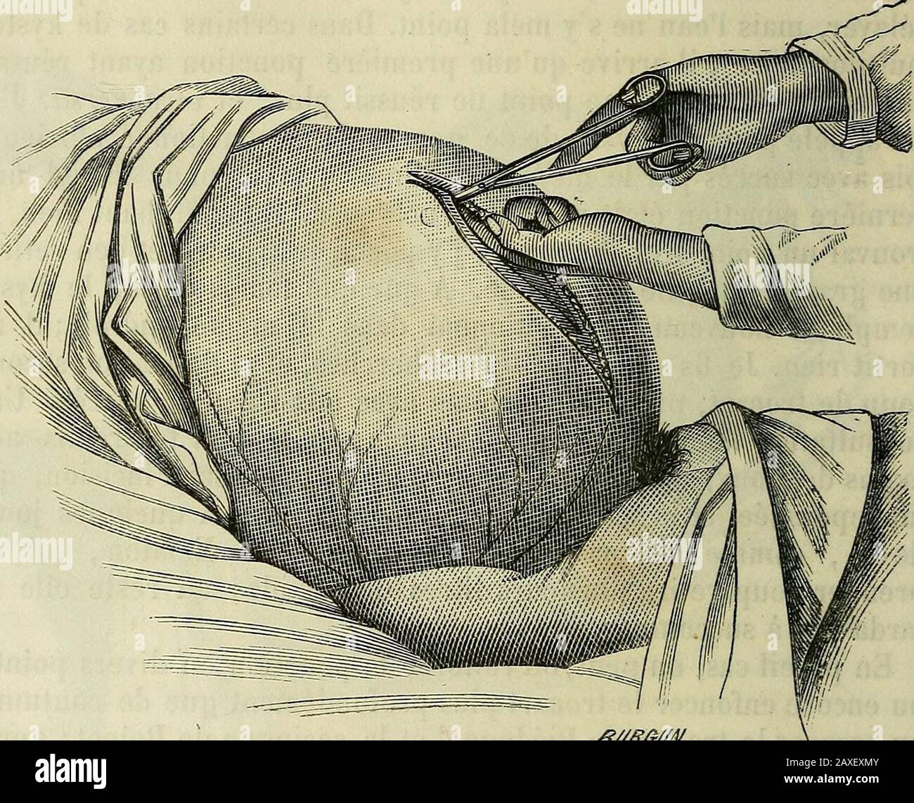 Manuel de médecine opératoire . tant un tra-vail dinflammation adhésive ou substitutive, par les injections;2° en les forisant suppurer ; 3 en enlevant le kyste lui-me. Première métJiode. Injections. — Boinet est le premier quiait tenté la cure des kystes ovariques par les injections iodées ; etelles sont repos longues temps adoptés. Le procédé est très simple.On fait la réponse à lordinaire, on évacuation tout le liquide; et parla canule on injecte immedidiation de 100 à 200 grammes de 34-2 OPÉRATIONS SPÉCIALES. Teinture diode iodurae médée dans des proportions divergentes.Linjection laissée à Banque D'Images