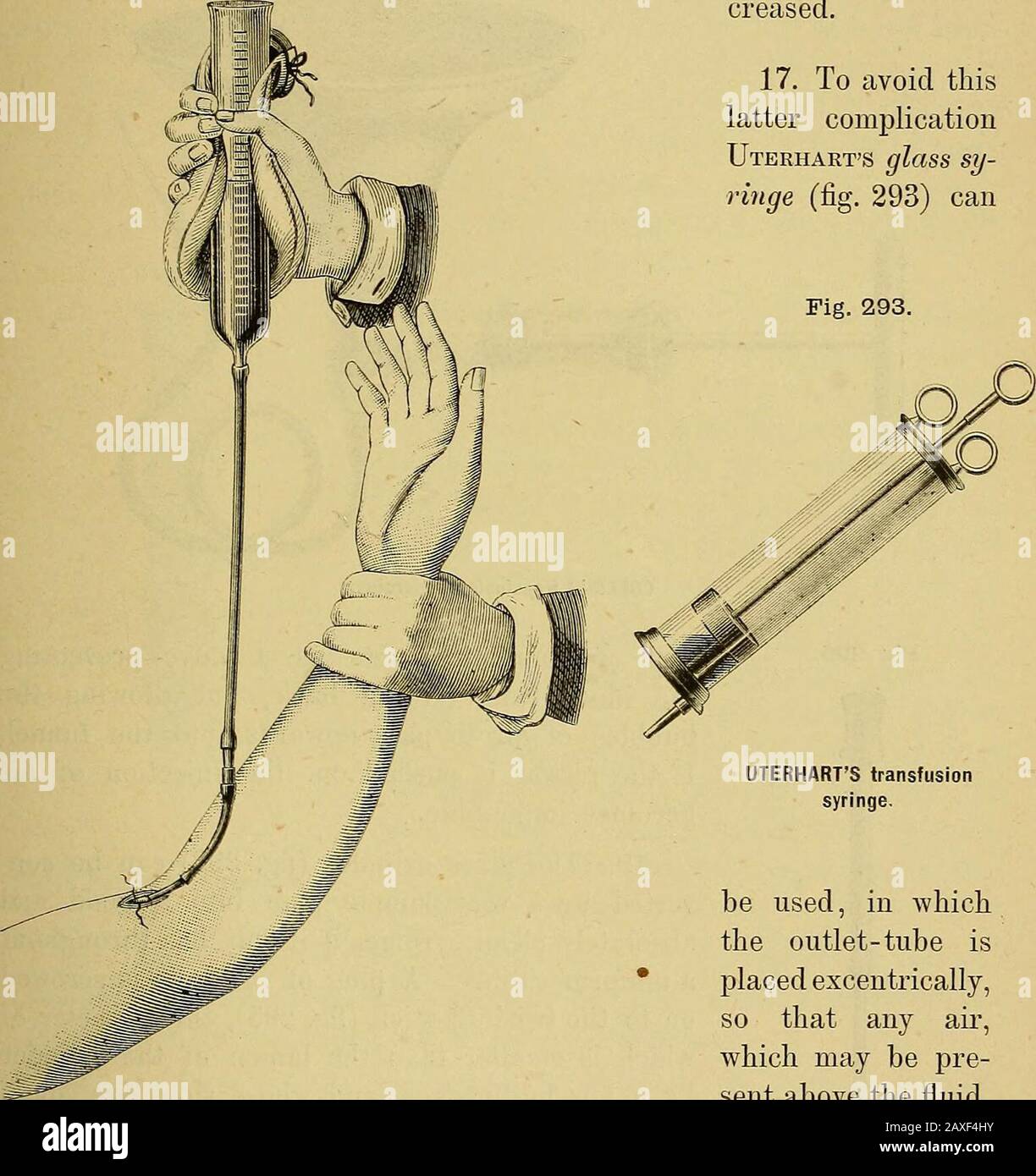 Le manuel du chirurgien sur le traitement des blessés en guerre : un essai de prix . t eau. 14. L'extrémité du tube est ensuite fixée au tuyau de connexion du canule (fig. 291). La bouteille en verre est levée d'une main, le bras du patient de l'autre, les deux clips sont déposés et la quantité de sang s'est lentement évacuée dans la bouteille en verre (fig. 292). 15. Dès que le cylindre est presque vide, le tube est enfoncé avec le doigt et le pouce. Le canule est retiré de la veine, l'extrémité centrale de la dernière divisée, la plaie a nettoyé avec de l'eau carbolique et une vinaigrette antiseptique appliquée Banque D'Images