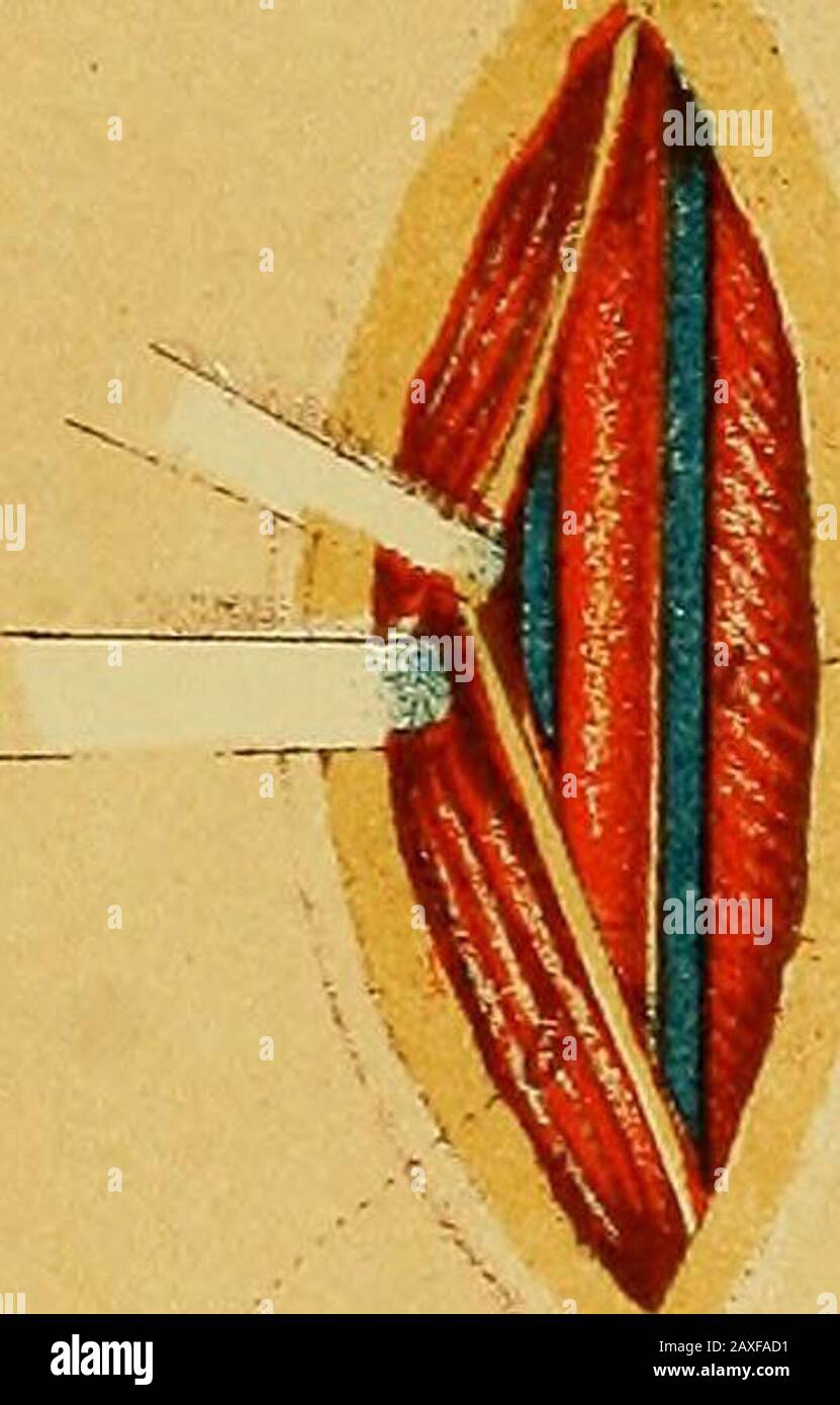 Le manuel du chirurgien sur le traitement des blessés en guerre : un essai de prix . e superficiel. 3. Le faisceau des nerfs est séparé, le cordon antérieur (n. me-dianus et cutaneus medius*) étant dessiné vers l'avant, le cordon postérieur (n. ulnaris et radialis) tiré vers l'arrière et la gaine de l'artériyouvert. * Par un contrôle, il est marché sur la plaque VIII comme cutaneus interims. 150 Ligature IX.plaque de l'artère brachiale au milieu du bras droit. 1. L'incision cutanée est. 4 cm de longueur le long de la limite interne des biceps. 2. Le biceps est tiré vers l'extérieur avec un enrouleur. La médiannerve est vue l Banque D'Images