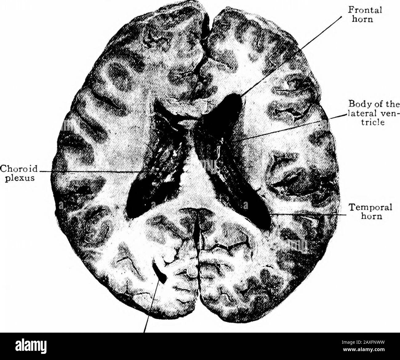 Un manuel d'anatomie . lobe sagittal. Le troisième ventricule {ventriculus tertius) est une clift verticale dans la ligne médiane entre les deux thalami et la dorsale du chiasme, du tubercule cin-ereum, du corpora albicantia et d'une partie du tégmentum du cruracerebri. Il est couvert, ou couvert par l'interpositum de velum. Itcontinue frontally comme une légère evagination, le renfoncement optique; ventral,il donne lieu à la renfoncement infundibulaire et dorsally, à l'épipJryseal,ou la renfoncement pinéal. Il communique avec chaque ventricule latéral par des foramen de Monro et caudalement avec le quatrième ventricule par méansde l'aqueduc. 414 LE Banque D'Images