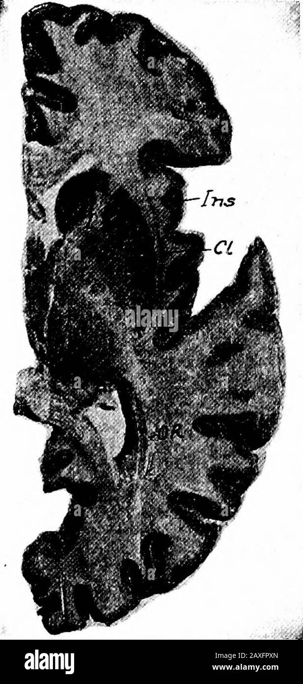 Un manuel d'anatomie . ay externe et thewhite interne placé, alors que totardle centre sont vus divers basalganglia. Juste à l'intérieur de la lateralmargin, près de l'extrémité frontale, est l'île de Reil, ou le lobe central (insula).Medial à ceci est le périclaustral (blanc) de la lamina couvrant la liserde gris, le claustrum. Cette isone des ganglions basaux et de la probablyreprésente une partie isolée du thécortex de l'insula. La médiale au thélaustrum se trouve une bande étroite de tissu nerveux blanc l'externalcapsule et le frontally, caudalement, et en dorsalement il se connecte à l'internalcapsule et représente Banque D'Images