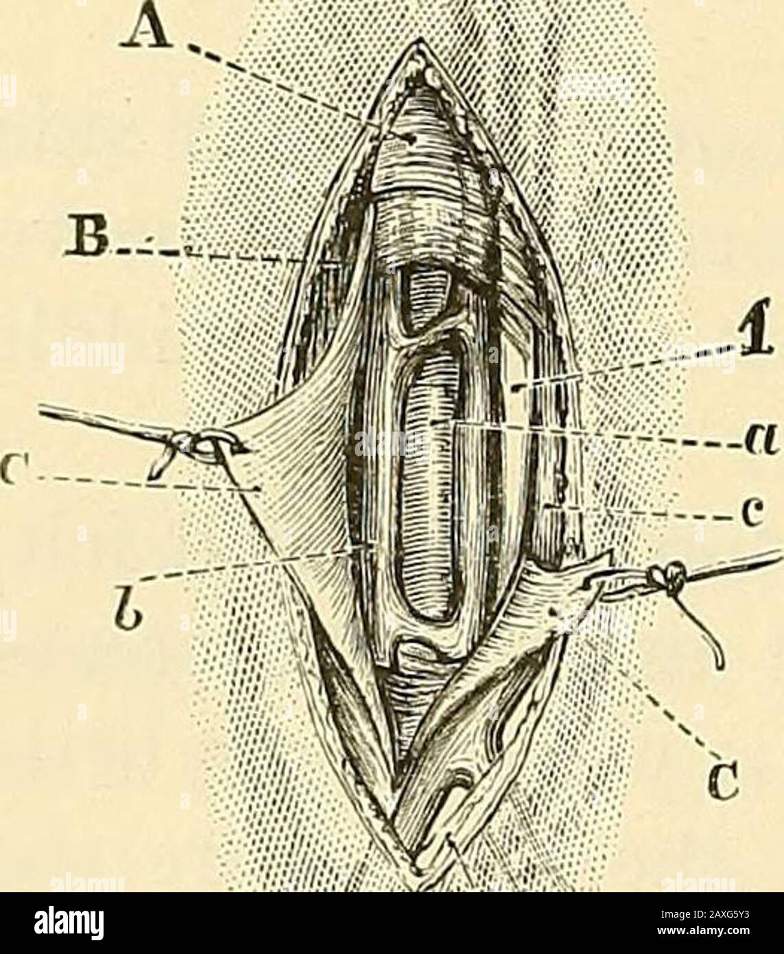 Un manuel de chirurgie opératoire . vers le bas des deux côtés du corps, debout sur le côté extérieur du membre du côté droit, et être-entre le tronc et le membre du côté gauche. Ou sur le côté gauche, l'opérateurpeut se placer sur le côté extérieur du membre, et, courber dessus, peut makelacer l'incision du dessous vers le haut. 1. Ligature au coude du coude. Fonctionnement.—le bras ayant été placé dans la position indiquée, le sur-geon, en fléchissant et en étendant le télimb, fait ressortir la position exacte du tendon du biceps, et en compressant les veines du bras supérieur rend évidente la basilicv médiane Banque D'Images