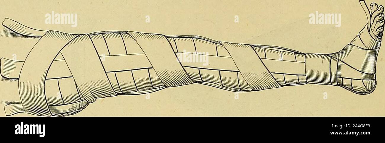 Le manuel du chirurgien sur le traitement des blessés en guerre : un essai de prix . VOLCKERS plâtre de Paris bandage avec bandes de bois. 1. Eamarch, Le Manuel Des Chirurgiens. 7 98 Fig. 211.. VdLCKERS plâtre de Paris bandage avec bandes de bois. 2. Sur ces quatre ou cinq rouleaux de plâtre humidifiés de Paris sont bandés, jusqu'à ce qu'il ait acquis la force nécessaire, qui peut être augmenté en posant sur une fine couche de crème de plâtre, ou en frottant dans un plâtre de Paris en poudre avec les mains préalablement humidifiées. Enfin, les extrémités saillantes des copeaux de bois sont removedavec une paire de ciseaux, et un Banque D'Images