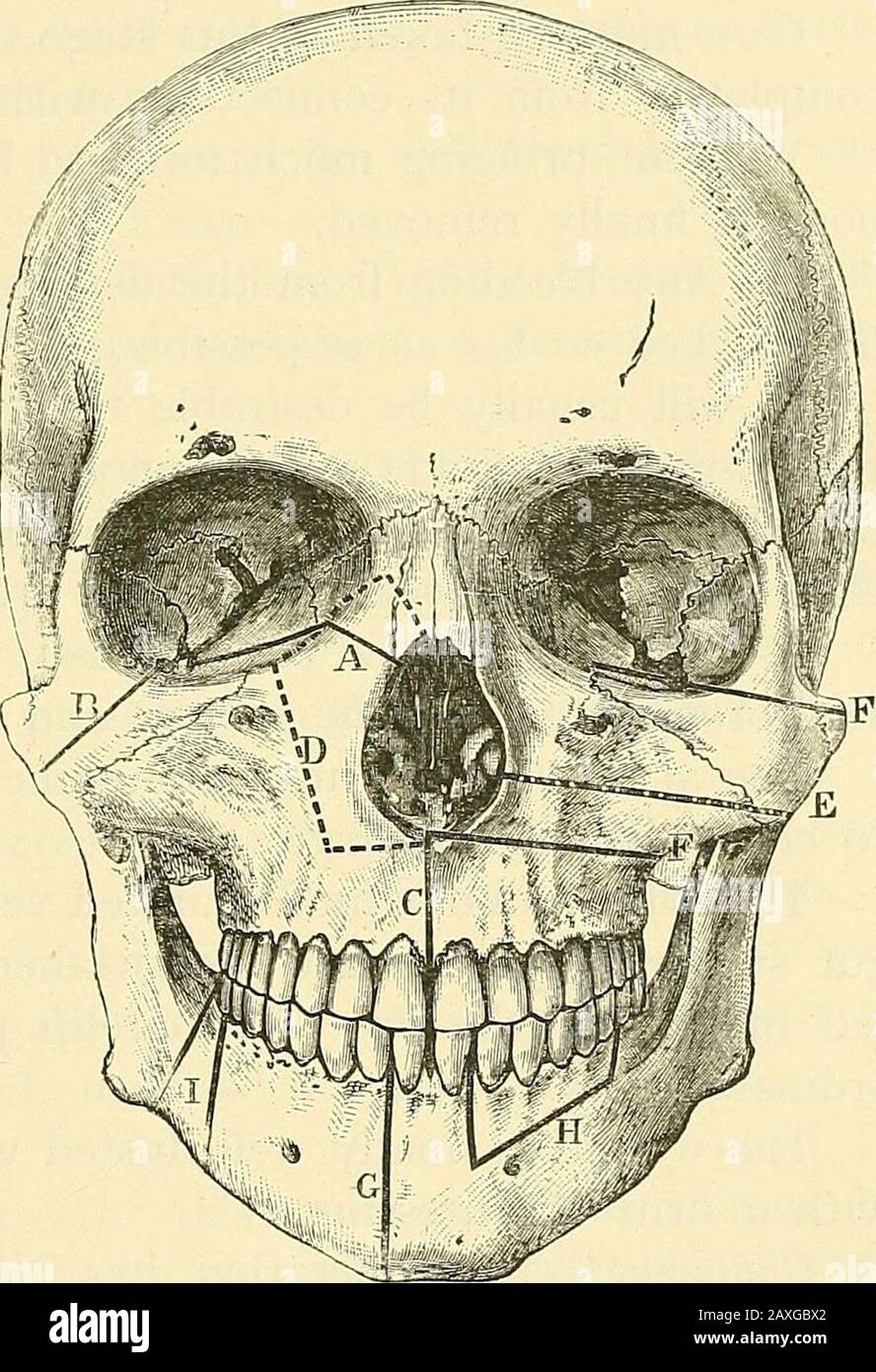 Un manuel de chirurgie opératoire . dont le site exact devrait être préalablement défini(Fig. 301, b). (5) La parte de l'os seul re-secteur avec ses con-nections non dérangé.La bouche ayant beenwell ouvert, la dent centralincisor sur le côté malade est re-déplacé, la couche muco-peri-ostéal du palais dur est didivideddans la ligne médiane, le couteau anda est dessiné allongle sol de la nosede avant vers l'arrière, et aussi près que possible du septum. Bymoyen d'une transverseincision faite à travers la bouche le Softpalais est sans serrer sepated de la dure. Une scie à trou de serrure est maintenant introduite TH Banque D'Images
