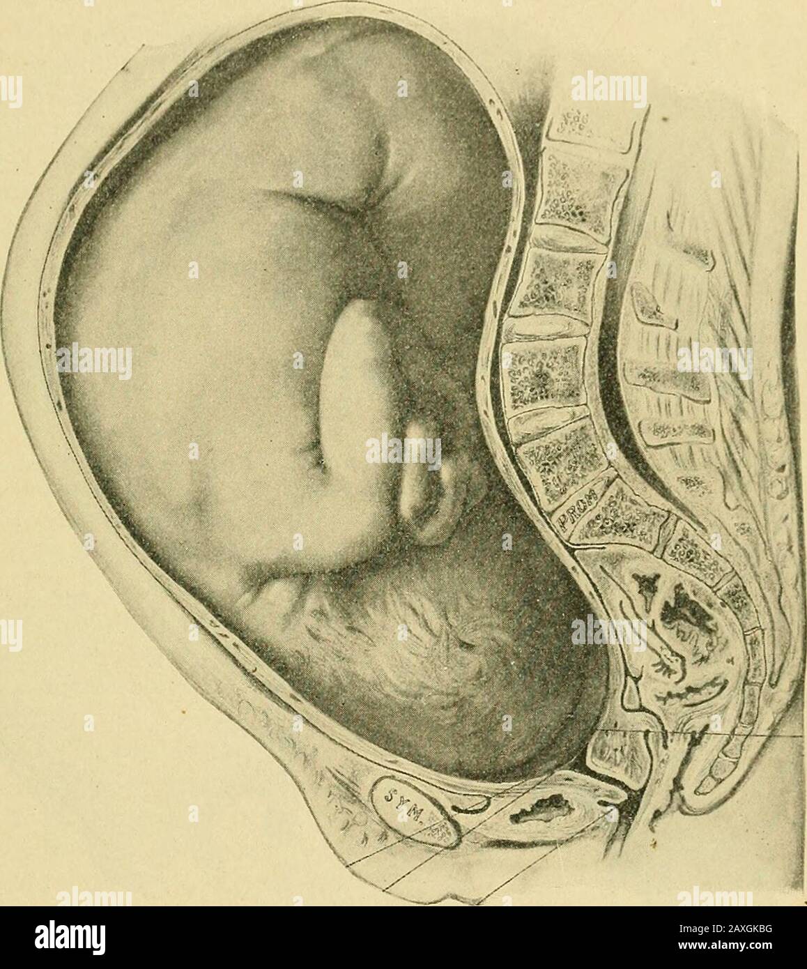 La pratique de l'obstétrique, conçue pour l'utilisation des étudiants et des praticiens de la médecine . et pyriform, le diamètre vertical étant le plus long (Fig. 132). Sa mesure antéro-postérieure est la plus élevée juste en dessous du milieu du corps. Duringle dernier de la grossesse il devient en forme d'oeuf, ovoïde, ou cylindrique (Fig. 137).Ces changements de forme se produisent dans l'utérus normal, mais peuvent être influencés par LA FORME DE L'UTÉRUS. 101 grossesses multiples, par anomalies de l'alcool amnii, et par pathologies. L'asymétrie du corpus uteri existe souvent même à une période très arlypérée de grossesse (Figs. 13. Banque D'Images