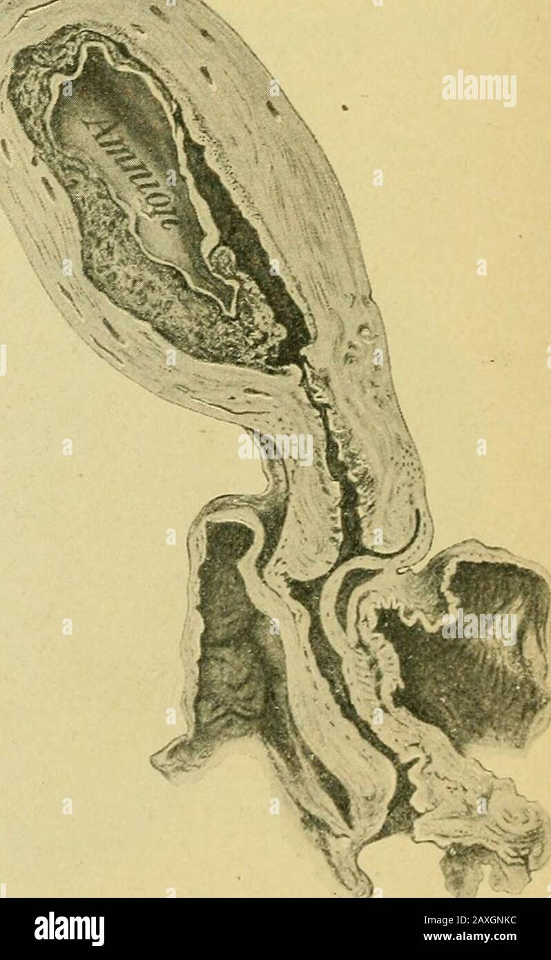 La Pratique De L Obstetrique Concue Pour L Utilisation Des Etudiants Et Des Praticiens De La Medecine Fig 130 Section Sagittale Du Contenu Pelvien D Uterusand Au Mois De La Grossesse Presentation Primigravida Breech Position Normale