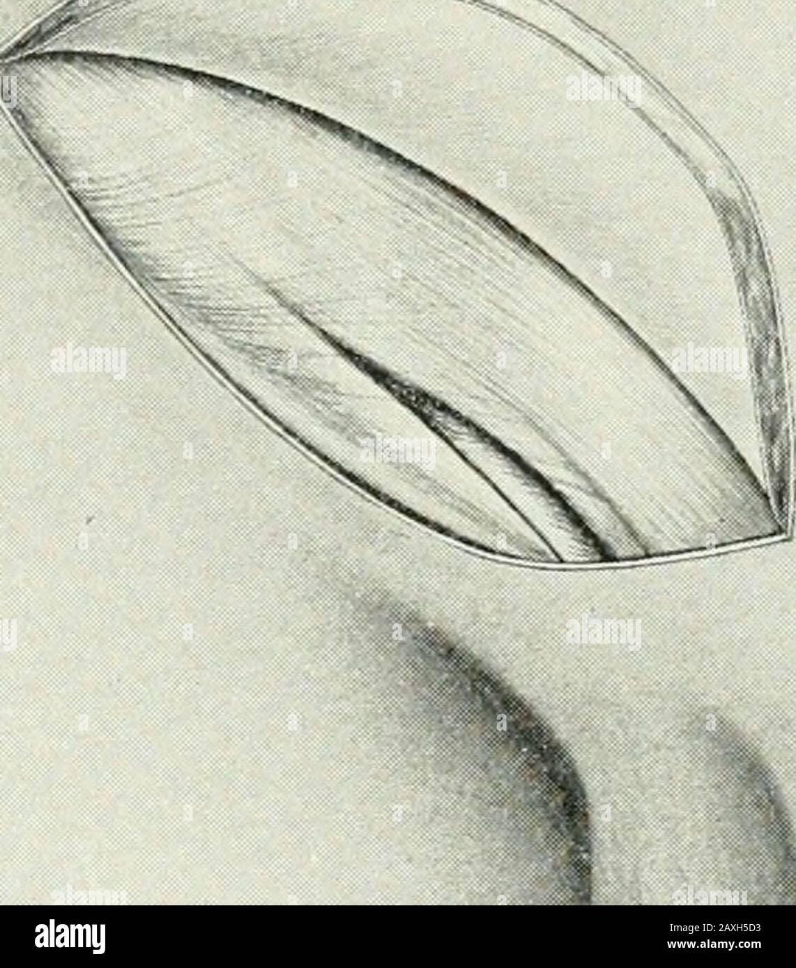 Annales de chirurgie . d la paroi postérieure du canal, ainsi que le site du triangle de Hesselbachs, se levèrent sur la surface palmaire du doigt. Avec la thelatter comme guide, les structures intervenant sont dipartidavec les ciseaux, la division incluant, de sans en service, le fascia transversalis, le tissu conjonctivepéritonéal sul et le péritoine. (Fig. 5.) le cordon spermatique est maintenant placé dans la péritonealcavité; l'écart dans la paroi postérieure incisée du canal inguinallaire est maintenu séparément en saisissant les édgesaux péritonéales incisées avec les pinces. Dans les cas où l'inter Banque D'Images