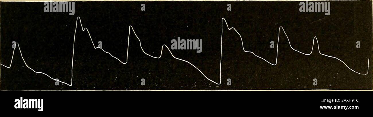 Maladies du coeur et du système artériel : conçu pour être une présentation pratique du sujet à l'usage des étudiants et des praticiens de la médecine . Fig. 131.—D'une femme de soixante-sept Ans, avec Arteriosclérose et Incompétence mitrale compensée par fairlyWell. La pulsation de bigéminisme est située plus près de l'avant-céding que le battement complet suivant, et que la seconde abortivelation dans le pouls trigéminal se trouve plus près du premier beattive que ce dernier à l'AVC complet. Les arythmies mentionnées jusqu'à présent peuvent être irrégulières dans la théirocassis, ou le prolo Banque D'Images
