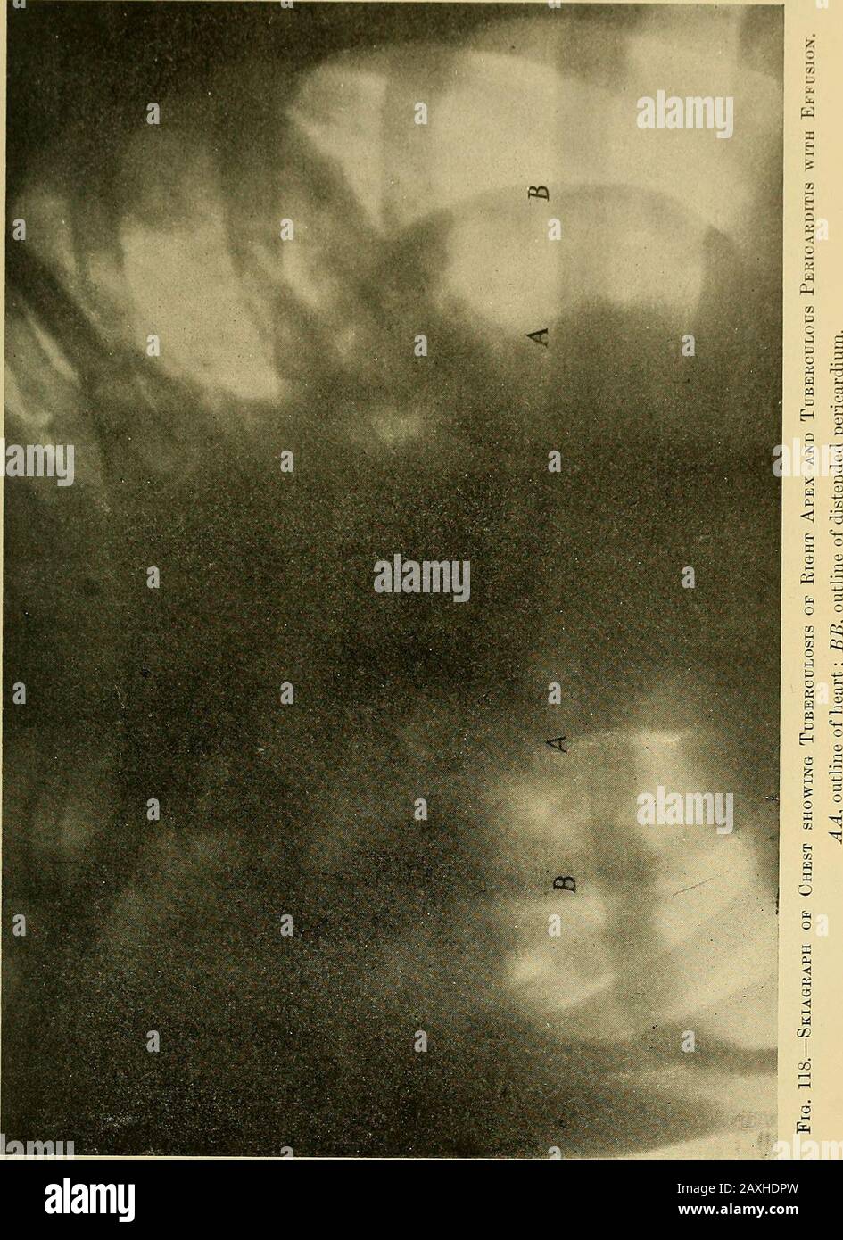 Maladies du coeur et du système artériel : conçu pour être une présentation pratique du sujet à l'usage des étudiants et des praticiens de la médecine . Williams estime que certains anévrysmscan sont plus certainement détectés par ce moyen que par tout autre examen de modeof. Il permet de déterminer leur emplacement et leur étendue et si la tumeur augmente ou non. Finalement, si l'anévrisme est situé à gauche, il est mieux vu depuis le dos, alors que ceux à droite du coeur montrent le meilleur de l'avant. Bien qu'il soit possible que même des observateurs qualifiés commiterro Banque D'Images