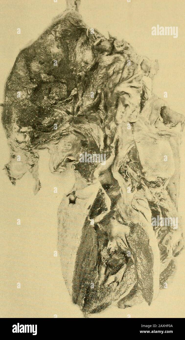 Maladies du coeur et du système artériel : conçu pour être une présentation pratique du sujet à l'usage des étudiants et des praticiens de la médecine . *S Figs. 113, 114.—Affichage de la toilette externe en cas D'Anévrisme aortique (voir Fig. 115). nécessite le port d'un bouclier métallique, plus la tumeur est frappée par l'acci-dentally et causée par l'éclatement. Fig. 113-115 montrent anévrisme dans cet emplacement qui avait un diamètre externe de plusieurs pouces. Je me souviens très bien d'un autre homme qui m'a été envoyé par le Dr G.Frank Lydston, qui m'a présenté une proéminence pulsatoire que oc-cupied l'ensemble des prsecordies, s'étendant d'un Banque D'Images