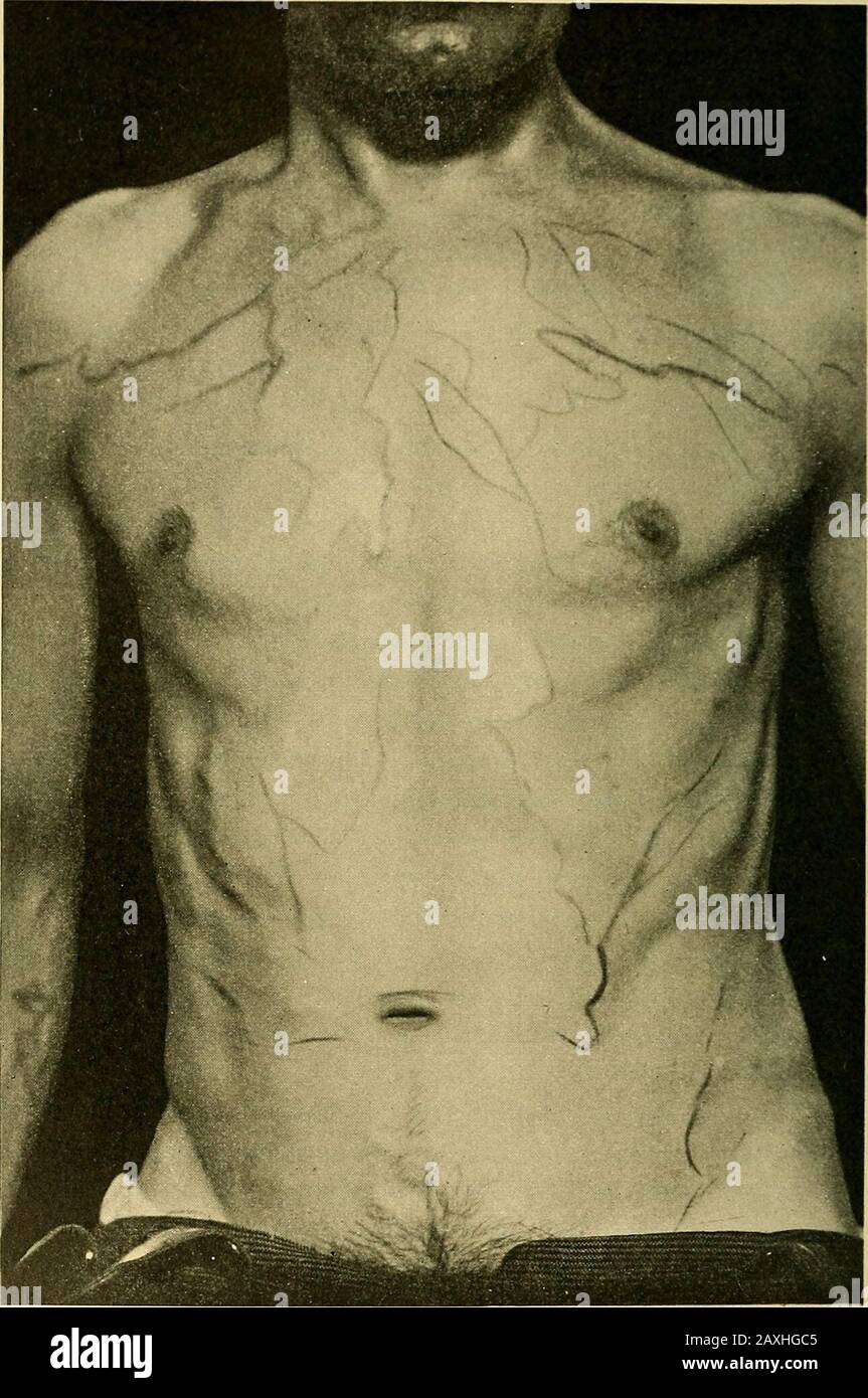 Maladies du coeur et du système artériel : conçu pour être une présentation pratique du sujet à l'usage des étudiants et des praticiens de la médecine . , de manière appropriée, ne forment pas une partie de l'histoire clinicalque des anévrismes thoraciques. Ils peuvent néanmoins être présents, et sont ensuite le résultat, en partie du moins, de la stase dans le système théaportail et ses affluents causés par la pression sur les grandes veines dans le thorax. Tous les anévrismes de la voûte plantaire n'ont pas l'occasion d'une interférence appréciable avec le flux sanguin en dehors du système veineux. Quand, cependant, un anévrisme atteint une taille considérable Banque D'Images