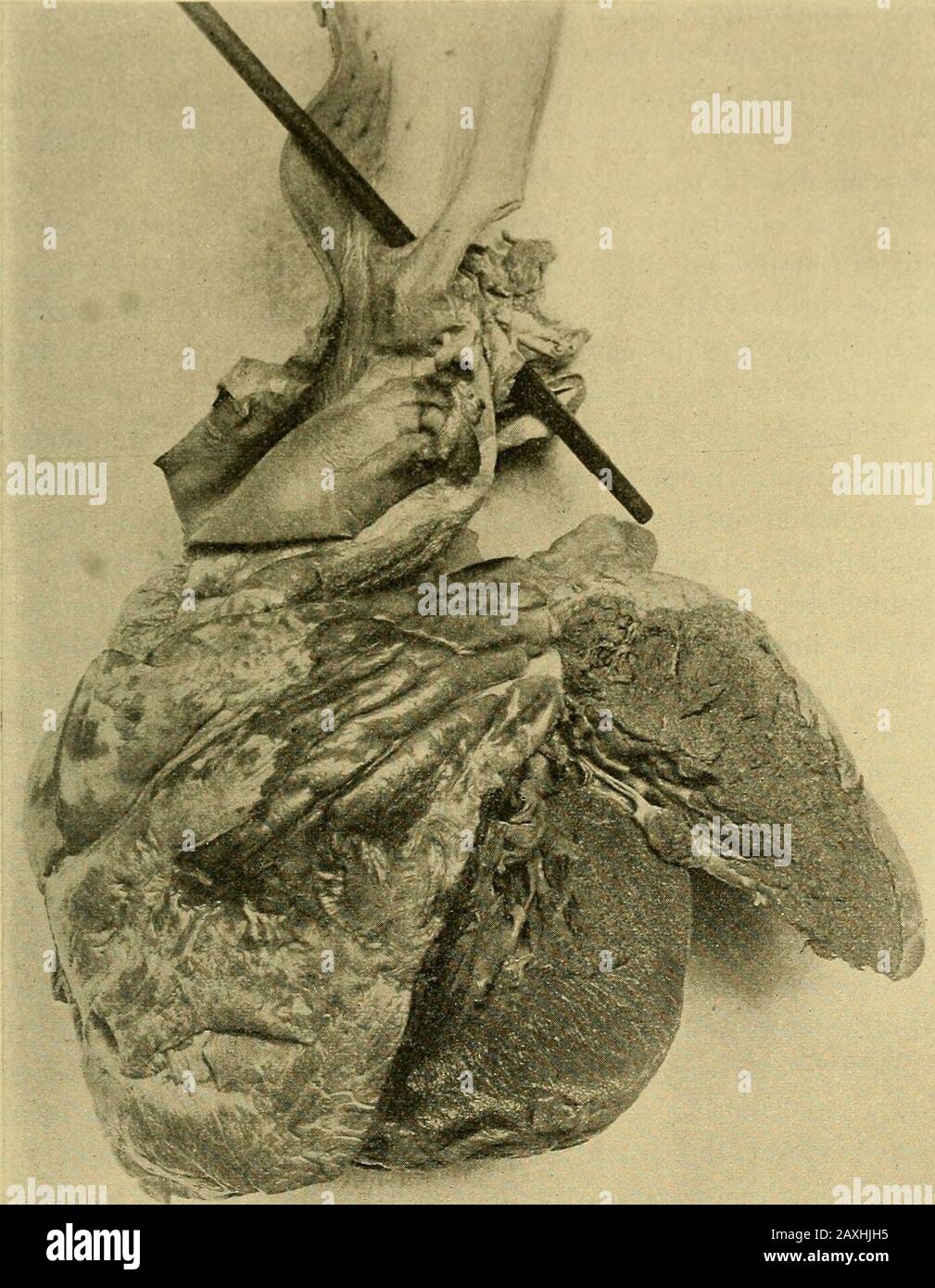 Maladies du coeur et du système artériel : conçu pour être une présentation pratique du sujet à l'usage des étudiants et des praticiens de la médecine . proéminent, en particulier à la hauteur du sternum, mais n'était pas pigeon-breasted. L'apex-beatwas dans le sixième interspace gauche, à 2 pouces du sternum, stronget diffus. Il y avait un frisson doux, pas très distinct dans les deuxième et troisième espaces à gauche près du sternum, qui n'était pas syn-chronous avec la systole ou la diastole, mais était la plupart pronouncedà la fin de l'expiration et le début de l'inspiration. Il semble suivre l'apex- Banque D'Images