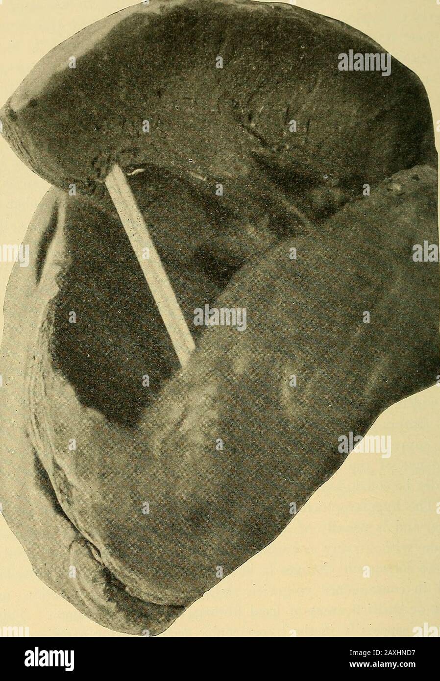 Maladies du coeur et du système artériel : conçu pour être une présentation pratique du sujet à l'usage des étudiants et des praticiens de la médecine . augmenter la largeur de la fibre, une augmentation correspondante de la longueur. Thesetwo facteurs qu'il considère suffisant pour tenir compte de l'augmentation avec-out en supposant toute augmentation numérique dans les fibres, et indevidence de ce dernier est vouloir. La question ne peut cependant pas être considérée comme réglée pour le moment. Le muscle hypertrophié est ferme, coupe avec une résistance accrue, et est habituellement d'une couleur rouge foncé. Augmentation des tissus musculaires sans c Banque D'Images