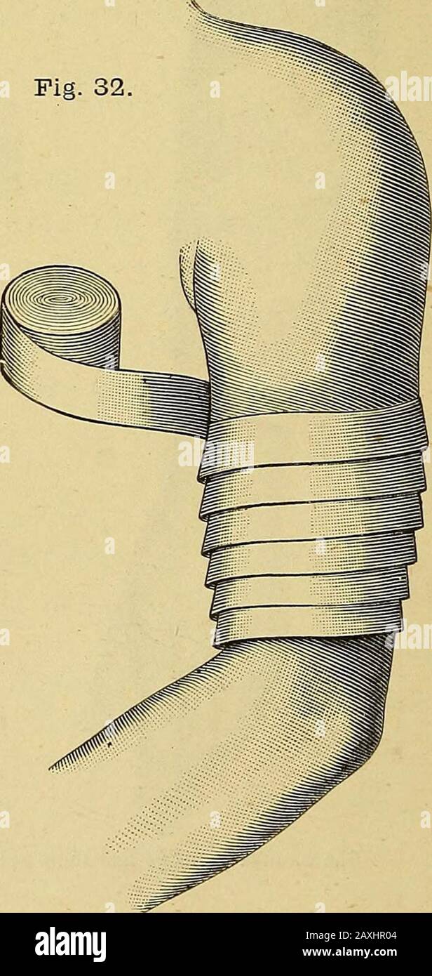 Le manuel du chirurgien sur le traitement des blessés en guerre : un essai de prix . Le descendant est seldomused, en raison de son retour de sang thevenous. 4. Bandage des byinvers (dolabra re-versa, renversee)(fig. 29—31) doit être utilisé, lorsque le thecircumférence du télimbe augmente ou diminue, de manière à éviter que le gappage des virages (fig. 32). Fig. 32. Bandage gélisant. 2 5. Le chiffre- de- huit (spica) est employé où le bandage passe sur un joint (fig. 33). Fig. 34. Fig. 33. Banque D'Images