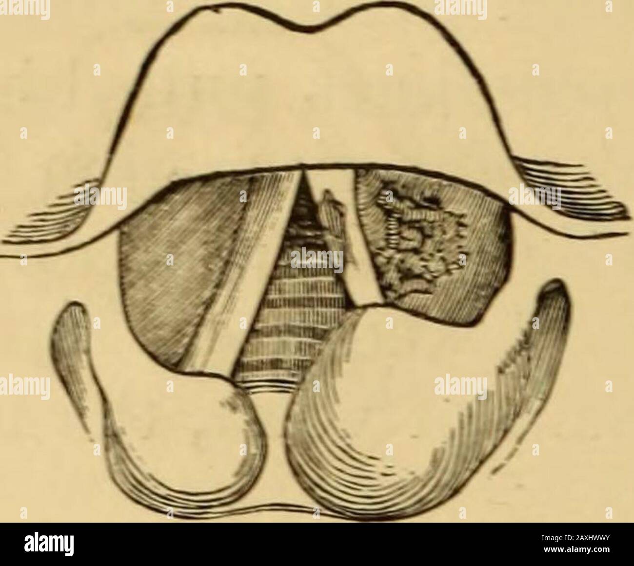 Maladies de la gorge et des voies nasales; un guide pour le diagnostic et le traitement des affections du pharynx, du sophage, de la trachée, du larynx et des nares . ngoftbeau* pr.1 :IT .1(111 652 AFFECTIONS DU LARYNX ET DE LA TRACHÉE. Côté (Pig. 194). et la pronation est ainsi effectuée. Dans les cas de forte tumfaction des tissus supra-aryténoïdes.comme dans le cas de la tuberculose, les apparitions sont similaires (Figs. 195 et. Banque D'Images