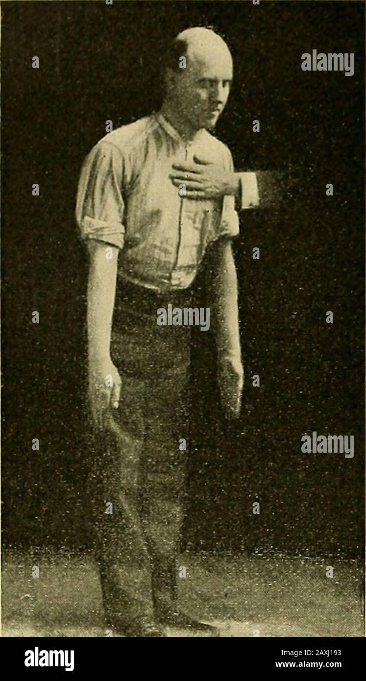 Maladies du coeur et du système artériel : Conçu pour être une présentation pratique du sujet pour l'utilisation des étudiants et des praticiens de la médecine . ists ce mouvement par placingune main contre l'épaule avançante et l'autre dans l'axilla opposée, et puis changer ses mains comme le corps est rotateddans la direction opposée (Fig. 92). (11) Dans ce mouvement, le tronc est plié latéralement, d'abord dans la direction inone, puis dans l'autre, et enfin est mis en position debout. Pour résister à cette flexion, le placesone de l'accompagnateur sur la hanche et l'autre contre le côté de la poitrine Banque D'Images