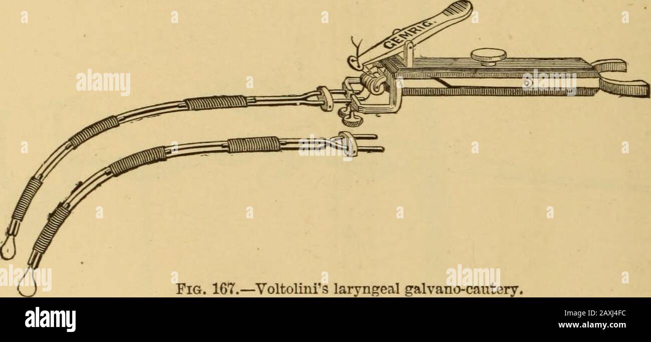 Maladies de la gorge et des voies nasales; un guide pour le diagnostic et le traitement des affections du pharynx, des sophages, de la trachée, du larynx et des nares . Fig. 166.—Tobolds chain ecrason (Tobold) Tobold a construit un vrai ecrateur (Fig. 166), providavec une chaîne délicate. J'ai essayé cet instrument à plusieurs reprises, mais je n'ai pas réussi à le manipuler avec succès. Fig. 167.—la galvane laryngée de Yoltolinis. La gallvano-cauterie, telle que suggérée pour la première fois par le professeur Middel-dorpf,1 de Breslau, est recommandée pour l'enlèvement ou la déstruc-tion des grognements laryngés, sur le score de la rigueur de l'action Banque D'Images