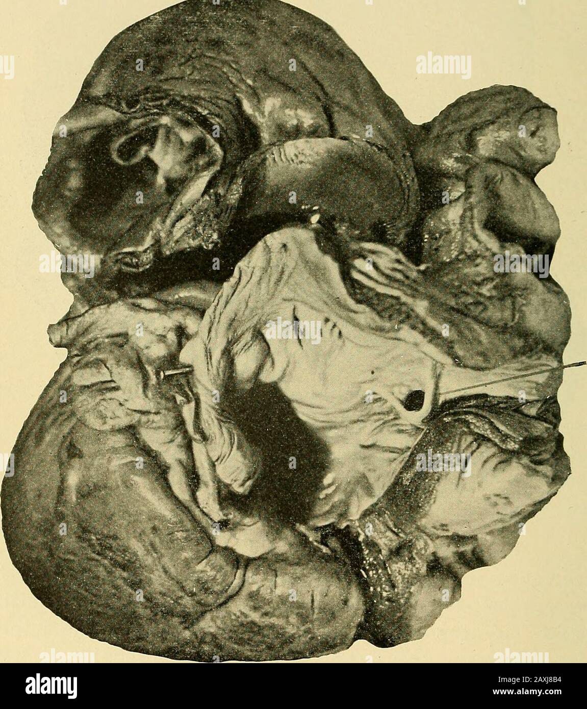 Maladies du coeur et du système artériel : conçu pour être une présentation pratique du sujet à l'usage des étudiants et des praticiens de la médecine . infirmé dans ses principales caractéristiques. Une inspection plus soigneuse du cœur, effectuée un an plus tard après avoir été conservée dans une solution de formaline, a montré que le cône projeté dans l'artère pulmonaire, et les valves semi-lunaires ont été composées d'un mém-brane uniforme, un peu plus épais que les valves normales, et n'a montré aucune linesor stries qui ont indiqué les points de fusion des cuspides. La théouvrature à l'apex était ovale, mesurant 15 millim Banque D'Images