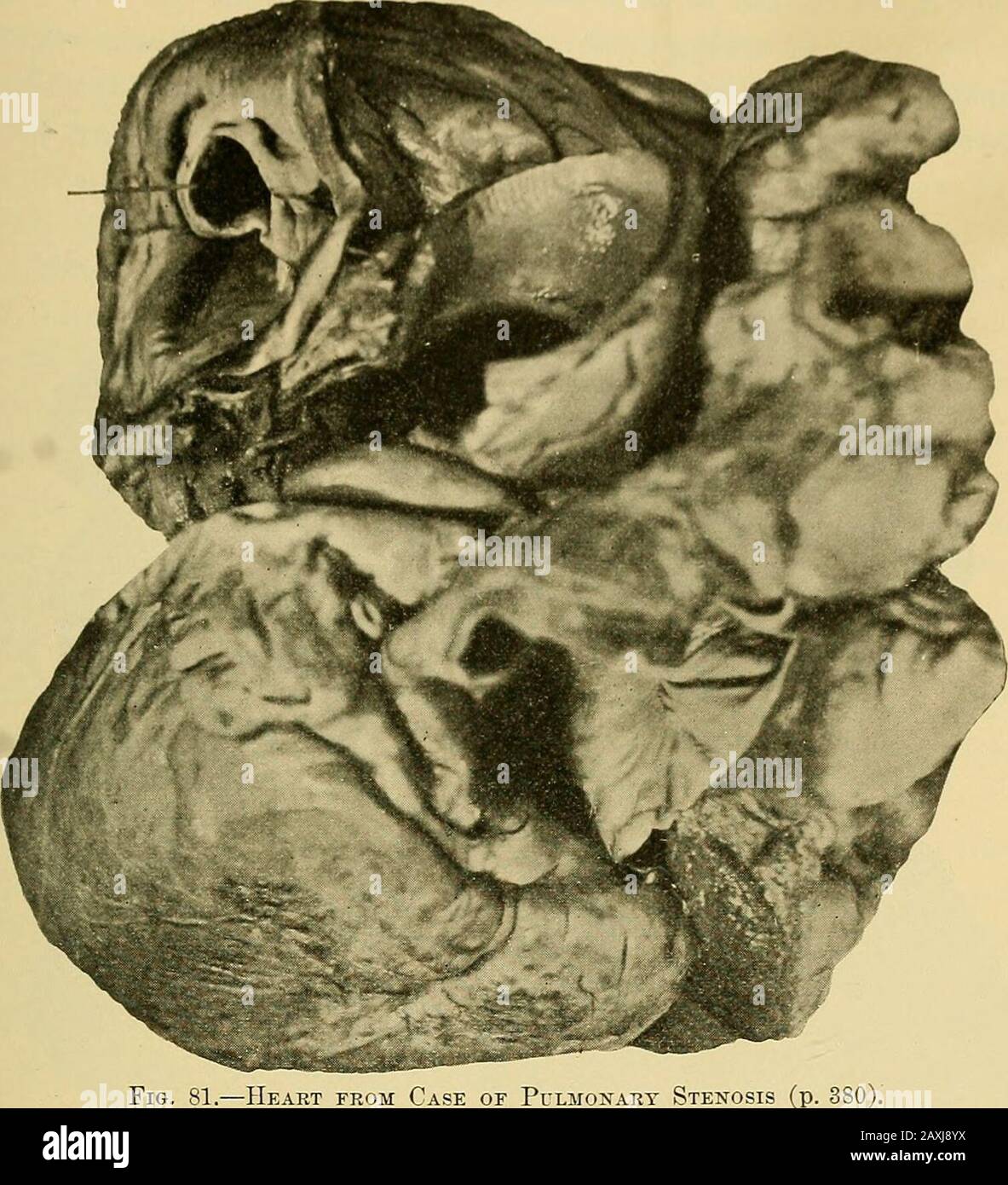 Maladies du coeur et du système artériel : conçu pour être une présentation pratique du sujet à l'usage des étudiants et des praticiens de la médecine . e que le droit. Les valves aortiques ne sont pas compétentes, mais les valves pulmonaires ont lentement fui vers l'essai hydrostatique. En regardant dans l'artère pulmonaire d'en haut, il apaisaredas si un mamelon avec une petite ouverture à son apex projeté dans le thevessel, et à un côté près de sa base était une deuxième petite ouverture, qui a été fermée en dessous par une membrane plus mince (Fig. 81). Le ventricule droit était hypertrophié et dilaté, et le cercle droit était un Banque D'Images