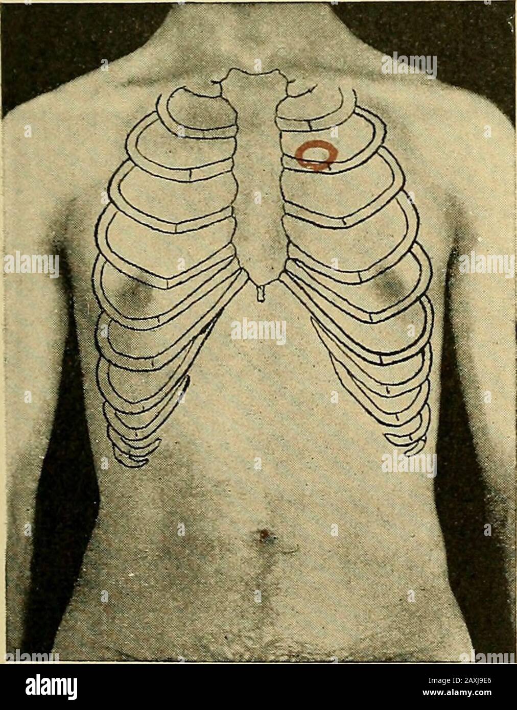 Maladies du coeur et du système artériel : conçu pour être une présentation pratique du sujet à l'usage des étudiants et des praticiens de la médecine . en se portant trop muchoin détail, il suffira tostate qu'il a présenté les symptômes habituels de la consommation, de l'amaciation, de la toux, de l'expectoration pro-fuse muco-purulente, de la température fébrile, anda rapide, feeble impulsion, les fonctions de l'organsrestant digestive bon. Il n'y a pas de cyanose. L'apexwas droit s'est rétracté et s'est mal étendu sur l'inspiration. Bothavices ont montré la dulité, la respiration bronchique, et les rales humides. Le prsecordium bulgedde t Banque D'Images