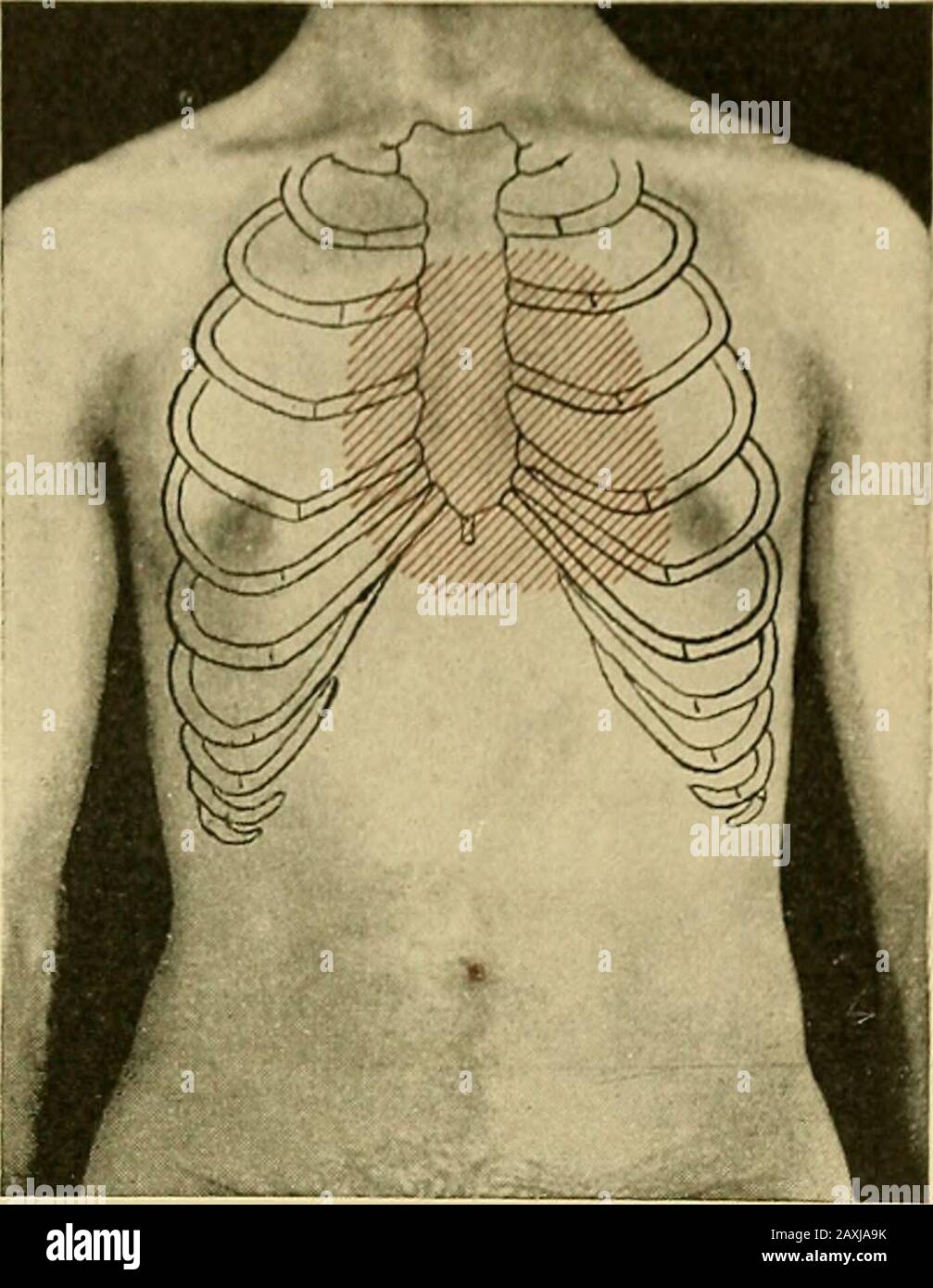 Maladies du coeur et du système artériel : conçu pour être une présentation pratique du sujet à l'usage des étudiants et des praticiens de la médecine . détresse et mauvaise santé. Mot INA, il n'y a pas de symptômes propres à la sténose pulmonaire ascontractée avec d'autres lésions valvulaires. Dans la forme congénitale, les patients sont susceptibles d'être faiblement, sous-dimensionnés, parfois déficients mentaux, et de manifester une frappe de cya-nose. Ce n'est cependant pas toujours présent. Dans le chapitre onCongénital des Affections cardiaques seront également considérés vérifierchangements dans le sang qui accompagnent la cyanose marquée ou le Mor-bus Banque D'Images