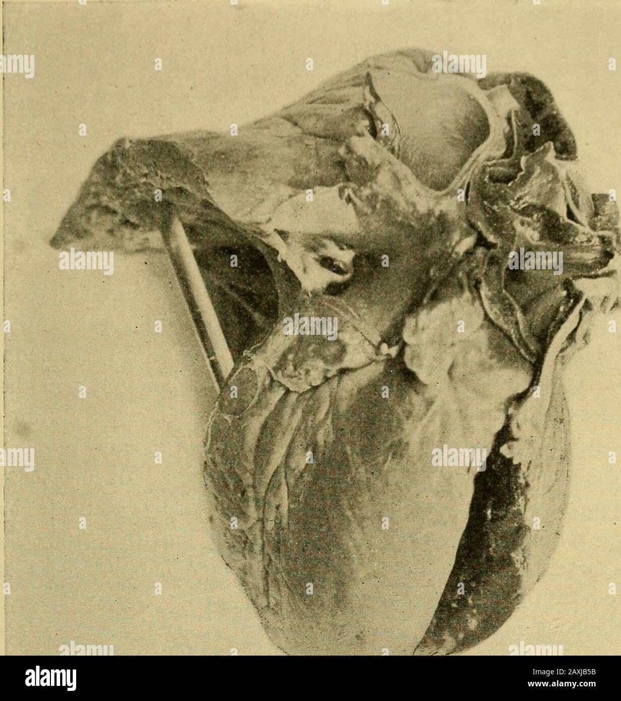 Maladies du coeur et du système artériel : conçu pour être une présentation pratique du sujet à l'usage des étudiants et des praticiens de la médecine . est généralement ouvert, et le septum interventriculaire isparfois incomplet. L'artère pulmonaire est toujours à croissance nar, et il peut y avoir une atrésie de ce vaisseau. Le canal artériel-sus est généralement ouvert, mais il est dans certains cas fermé. Veryrarement, la sténose est causée par une constriction de la conusartériosus droite, dans laquelle le cas peut apparaître comme un troisième ventricule, et les septa interventriculaires et interauriculaires sont des défauts-ive, la pu Banque D'Images