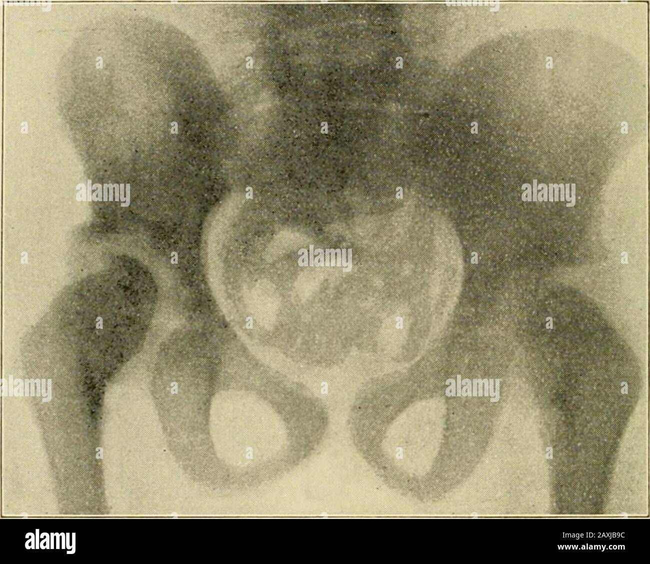 Ueber die Heilung der angeborenen Hüftgelenks-Verrenenkung durch unblutige Einrenkung und fonctionnelle Belastung . wurde die Repositionner nicht nur fürdie indifferente Streckstellung, sondern sogar für die Adductionstabil. Die linke Pfanne ist ungleich flacher, nach unten zuoffen, nach oben zu verschwommen abgegrenzt. Der Schenkel-kopf tritt mit seiner lateralen Hälfte unter dem wenig ent-wickelten Pfannendache vor. Aber an der lateralsten Kantedesselben sind büschelförmig nach unten und aussen aus-strahlende opake Knochenschchatten aufgetreten, welche in einenach unten ragende Spitze — die in Neubi Banque D'Images