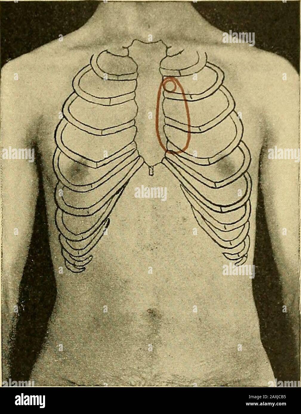 Maladies du coeur et du système artériel : conçu pour être une présentation pratique du sujet à l'usage des étudiants et des praticiens de la médecine . -ment du foie. Ainsi farlà n'a rien dans l'ex-amination du patient pour m'impressionner comme inhabituel. Quand, cependant, l'explora-tion du coeur a commencé, Iwas à la fois frappé par le for-cible et la cardiacpulse étendue, qui a atteint de la mamelon gauche dans l'épigas-trium, tout à travers la ligne médiane à droite al carti-lages, et jusqu'à asto le niveau de la huitième. Ce n'était pas à la fois reconnu comme l'impulsion du Banque D'Images