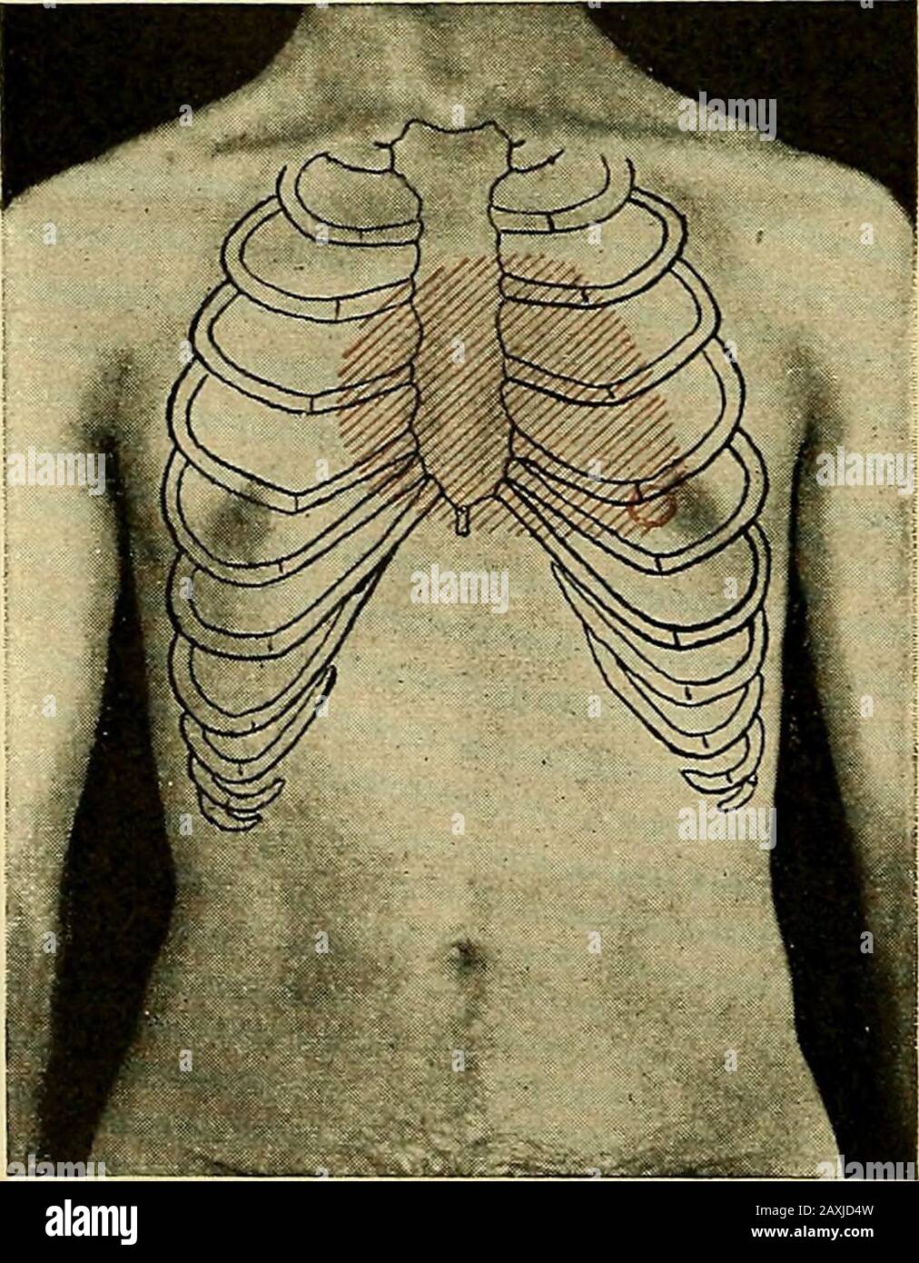 Maladies du coeur et du système artériel : conçu pour être une présentation pratique du sujet à l'usage des étudiants et des praticiens de la médecine . De manière séquestuelle, la reconnaissance de ces signes dans ce seul domaine ne saurait être aussi suspecte que la détection, dans mon cas, de ces phénomènes pal-patoires dans deux situations distinctes et distinctes. Percussion.—la dulité cardiaque est augmentée au-dessus du cercle droit de l'auri, c'est-à-dire à droite du sternum, mais ce n'est pas distinctif, puisqu'il se produit de même dans la maladie mi-trale (Fig. 74). Sténose Intricuspide il est likelyà être particulièrement bien marqué Banque D'Images