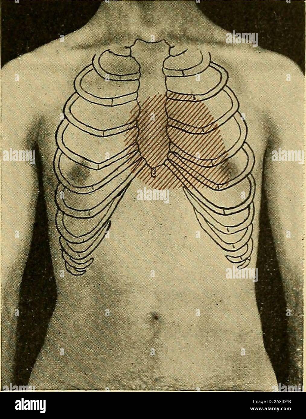 Maladies du coeur et du système artériel : conçu pour être une présentation pratique du sujet à l'usage des étudiants et des praticiens de la médecine . la cardiopathie peut être due à une affection cardiaque ou pulmonaire associée ou antécédent. L'emphysème vésiculaire, l'effu-sion pleuréritique chronique ou l'hydrothorax, et la cirrhose du poumon droit, peuvent renoncer à toute tentative de déterminer par percussion la précision du coeur droit. Dans l'emphysème vésiculaire, les frontières des poumons sont distendues, poussant le coeur loin de la paroi thoracique et provoquant une telle adége de l'hyperrésonance thatthe Banque D'Images