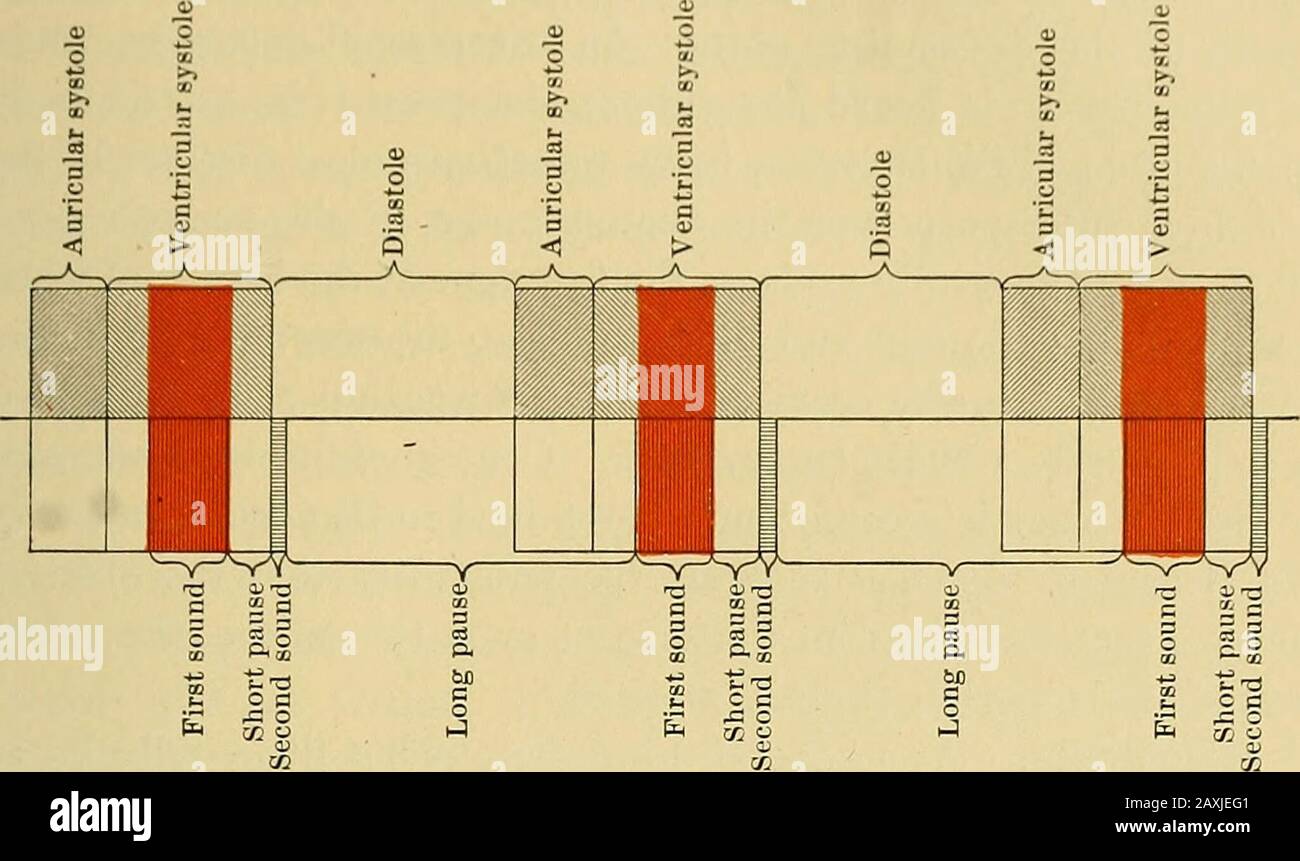 Maladies du coeur et du système artériel : conçu pour être une présentation pratique du sujet à l'usage des étudiants et des praticiens de la médecine . Fig. 67.—Incase relative typique d'AorticStenosis Bien compensée. L'OS ST KN aortique EST de 337 mi (unensurate avec le degré d'hypertrophie ventriculaire gauche ( Fig. &lt;»7). Ce n'est que lorsqu'une compensation défaillante a été lésée à une congestion pulmonaire ou lorsque la sténose aortique est unie à un Fig. 68.—Eythm du Souffle obstructif aortique. Défaut mitral, que la percussion détecte toute augmentation de la dulité cardiaque absolue et relative au Banque D'Images