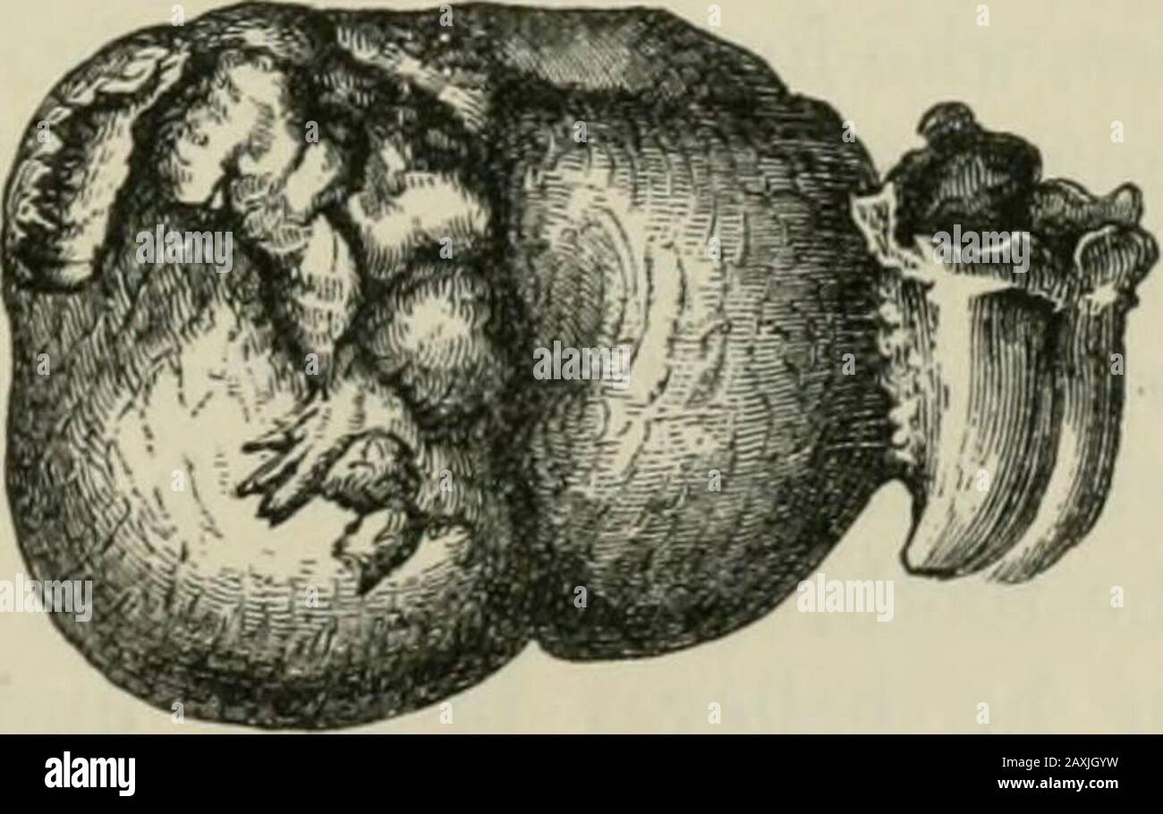 Blessures et maladies des mâchoires . Fig. 89.. Oubliez {op. Cit.). Il s'est produit dans la pratique de M. Maison-neuve, et dans la personne d'un homme de quarante ans. Le tumorait le côté gauche de la mâchoire inférieure, provoquant le projet des deux surfaces, mais surtout l'extérieur. Au niveau des 192 TUMEURS plus petites RELIÉES AUX DENTS. L'extrémité de la tumeur était une dent molaire dédosée, et l'uponextrayant cette tumeur est venue avec elle. La croissance, qui était plus grande qu'un oeuf de pigeon^s, était attachée à la dent par une sorte de pédicelle, une section montrant une ligne d'oséparation entre elle et la racine de la dent. Sous eux Banque D'Images