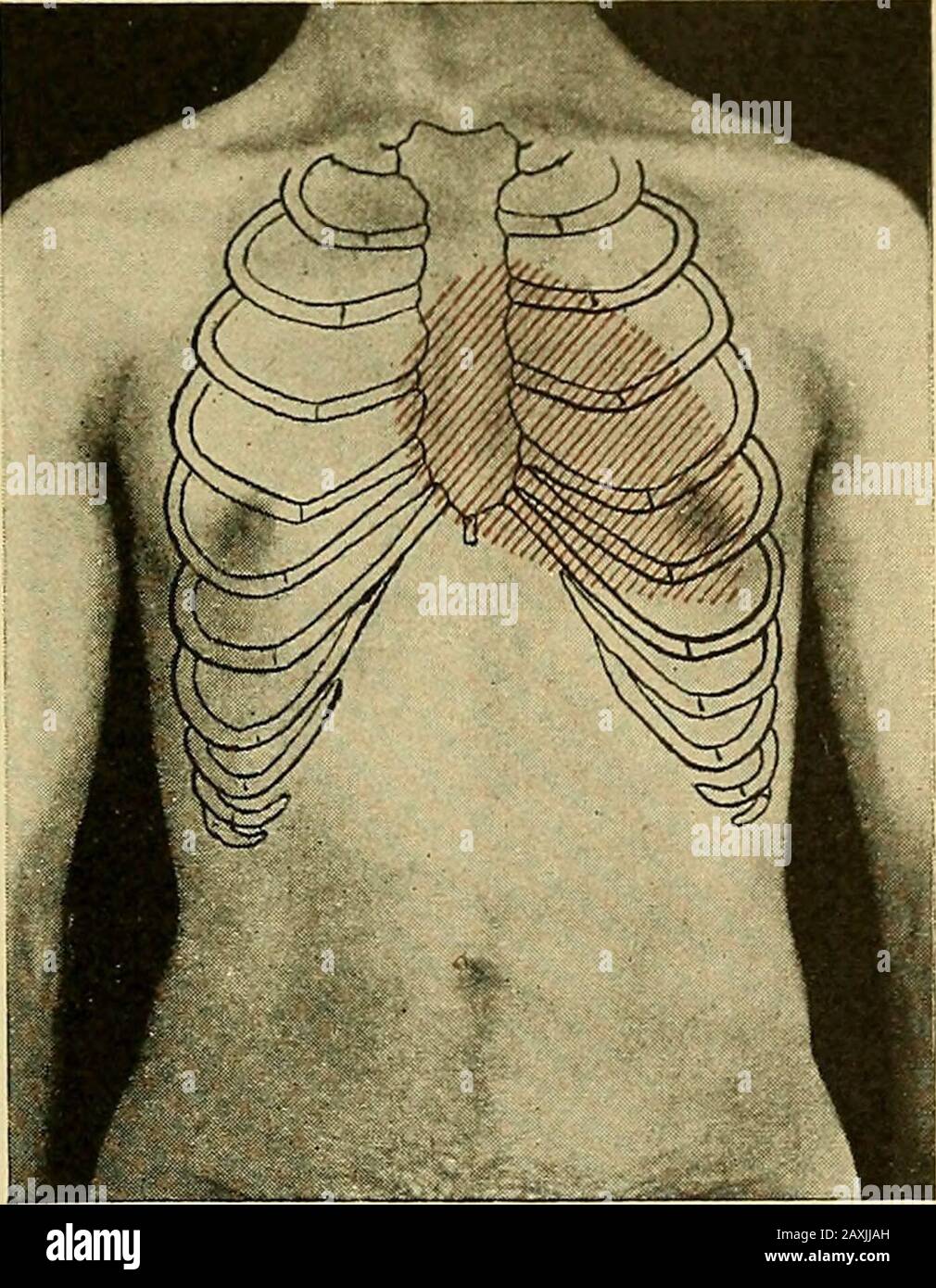 Maladies du coeur et du système artériel : conçu pour être une présentation pratique du sujet pour l'utilisation des étudiants et des praticiens de la médecine . e coeur - muscle a été notassez sain et si le thatrun a commencé un étirement de l'anneau aortique qui a été beenaugmenté en succédant ef-forts, ou si la souche a été lédsur une aortitis ou un anévrisme, et ceci à l'insuffisance des thevalves ? Rupture d'un cuspid hors de la question, être cause de l'absence de sériousssymptômes dans les semaines imme-dialement réussi sa course. La valvulite antérieure était notimorable, car il est bien connu que l'énorme secon Banque D'Images