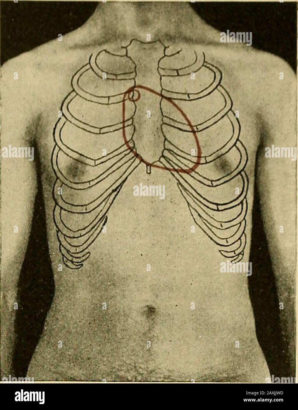 Maladies du coeur et du système artériel : conçu pour être une présentation pratique du sujet à l'usage des étudiants et des praticiens de la médecine . RÉGURGITATION aortique .,:, seulement dans le quatrième interspace gauche, près de l'os du sein. Il : est généralement le plus distinct dans la position erecl ou lorsque le ouï tsaction est excité. Neverthe-less J'ai certainement observedcas dans lesquels le murmur être-est venu plus distinct et easilyreconnu quand le patientwas recumbent. Ce murmuris est transmis vers le bas vers les pupilles l'annexe ensiforme, et dans certains cas alsotoward la gauche, même aussi fara que l'ap Banque D'Images