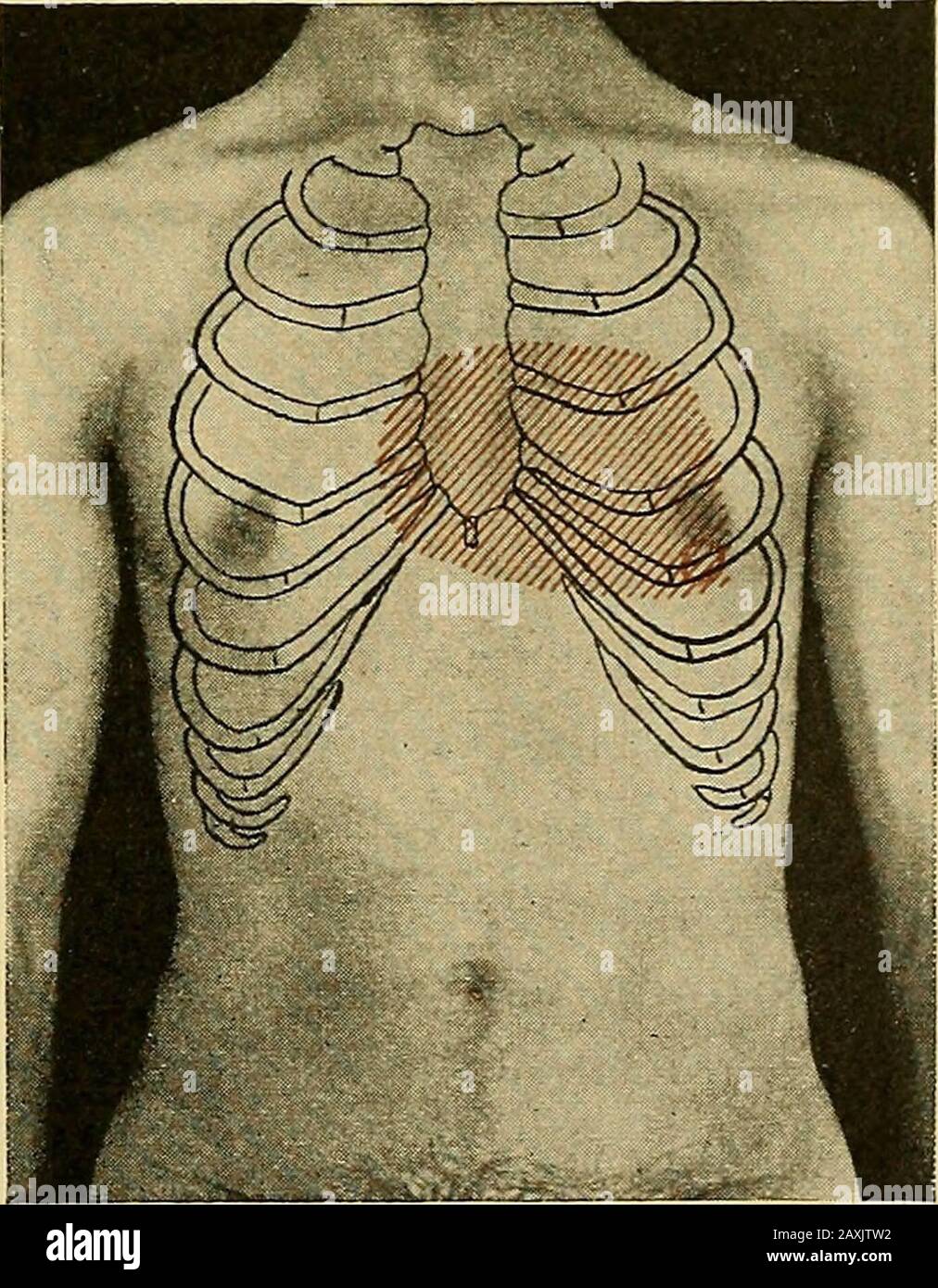 Maladies du coeur et du système artériel : conçu pour être une présentation pratique du sujet pour l'utilisation des étudiants et des praticiens de la médecine . semble corroborer la vue thatdropsy dépend de l'état du sang et de la nutrition des théapillaires, comme wrell que sur le degré de capillaire et venousengangement. Ce patient a ensuite succombé à une trentaine de points de données dans l'hôpital. M. B., âgé de vingt-neuf ans, tailleur, m'a consulté le 9 janvier 1900, en raison d'une grande essoufflement sur le moindre effort.Il a donné une histoire de rheuma-tisme quatre ans auparavant, depuis quelle époque il avait Banque D'Images