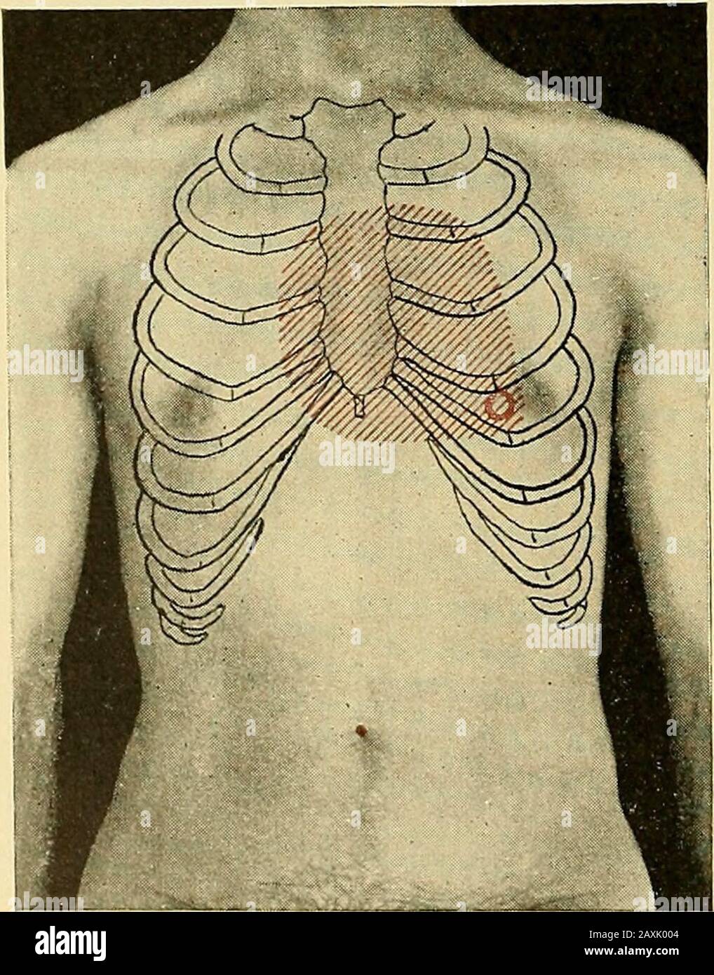 Maladies du coeur et du système artériel : conçu pour être une présentation pratique du sujet à l'usage des étudiants et des praticiens de la médecine . s-apparaissent avec la restauration de l'énergie cardiaque, Popoff attribue theinégalité à la pression de l'auricule gauche fortement dilatée sur l'artère sous-clavière gauche. Preble a également remarqué son occurrence dans certains de ses cas. Comme le pulsus différents peuvent également être produits par l'aneu-rysme, l'embolie, la thrombose, l'artériosclérose, etc., il est important que toutes ces causes soient ex-cluded avant que la phénoméronis soit attribuée à l'extrême dila-tation de l'auricule, un tapis Banque D'Images