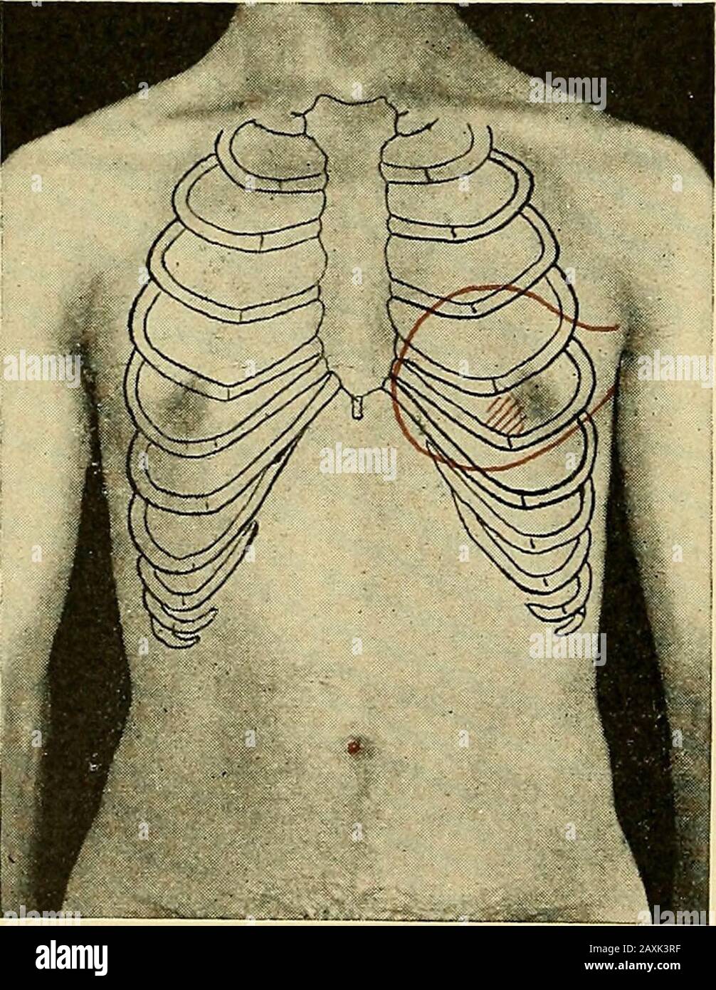 Maladies du coeur et du système artériel : conçu pour être une présentation pratique du sujet à l'usage des étudiants et des praticiens de la médecine . leflux sanguin, et sont appelés murmures. Il est clair que de nombreux facteurs dif-ferents influencent le caractère d'un murmure, et que l'information ifiable doit être dérivée de l'étude d'un murmur les caractères propres à l'eachdoit être compris. L'indica auscultatoire de la régurgitation mitrale, alors, est une murmure systolique avec un maximum d'inten-sity dans la région mitrale - c'est-à-dire à ou près de l'apex-battement(Fig. 40). Un tel bruit, hurlez Banque D'Images