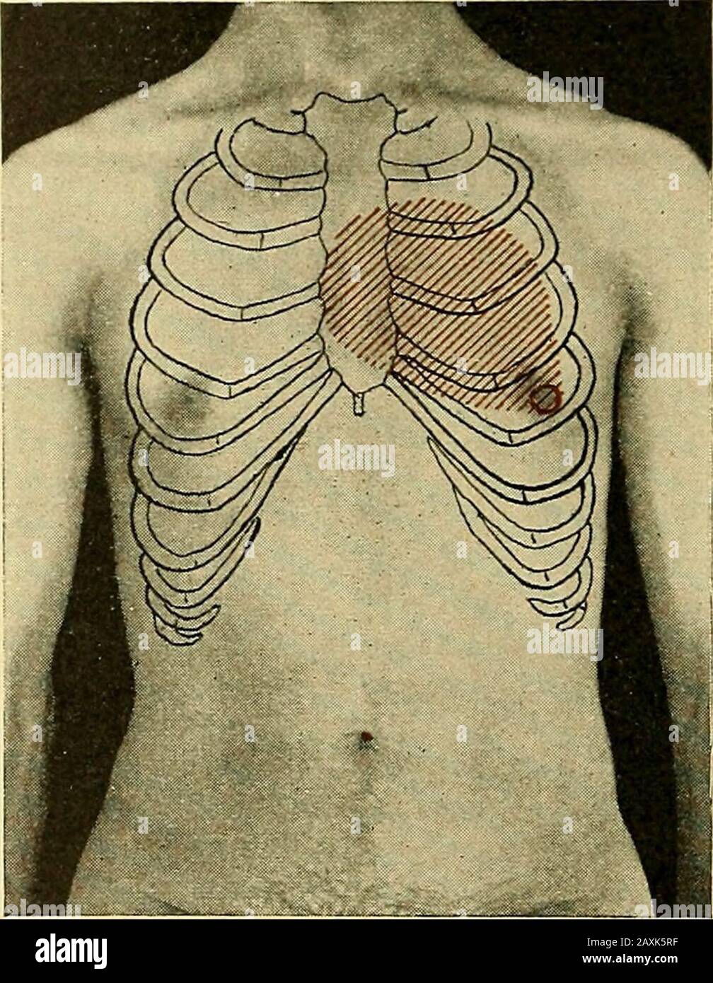 Maladies du coeur et du système artériel : conçu pour être une présentation pratique du sujet à l'usage des étudiants et des praticiens de la médecine . eback. Le foie était barélipalpable, mais tendre dans le re-gion de la vésicule biliaire, mais à d'autres égards l'abdomenwas négatif. L'conditionétait simplement une régurgitation mitrale d'origine rhumatismale, avec une compensation imparfaite en raison de la souche quotidienne à quellele coeur a été soumis. Ce cas est intéressant en raison du fait que, bien que le patient ait admis la dyspnée et la cyanose à un effort physicalenté inhabituel, elle était encore principalement perturbe Banque D'Images