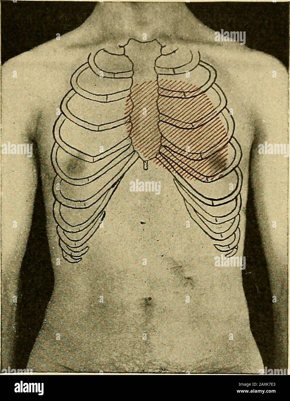 Maladies du coeur et du système artériel : conçu pour être une présentation pratique du sujet à l'usage des étudiants et des praticiens de la médecine . ur et a établi l'ex-istence de la régurgita mitrale-tion. La perte de bruitème systolique aortique du second son aortique, ainsi que le frisson sys-tolique, ont donné des preuves d'origidité, et peut-être sténo-sis des valves aortiques. L'absence d'une histoire rhumatismale, l'âge des patients, le développement tardif des symptômes, la modération de l'athérosclérose, et enfin, les résultats du coeur, tous semblaient à la guerre-rant l'opinion que les changements valvulaires étaient du Banque D'Images