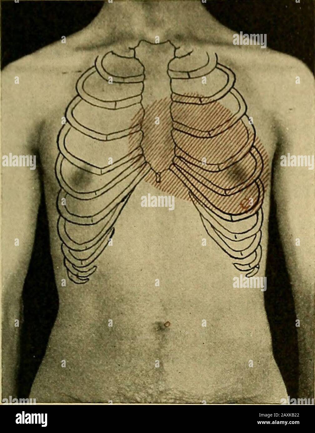 Maladies du coeur et du système artériel : conçu pour être une présentation pratique du sujet pour l'utilisation des étudiants et des praticiens de la médecine . otant plusieurs degrés, mais courant si milda cours comme mériter à peine l'appellation de pyrexie. Dans d'autres, encore une fois, l'élévation de la température est de type irrégulière, ou il y a des fluctuations diurnes, à éventuellement 101,5° ou even102,5° F. la caractéristique qui attire principalement l'attention dans les cas est l'anémie progressive, et les changements trifling disdiscov-pered dans le coeur sont proportionnels à ceux de l'anémie. Le dernier juillet 1900, je wa Banque D'Images