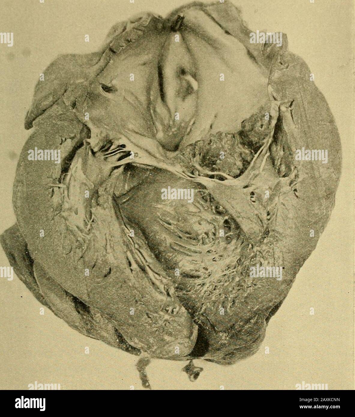 Maladies du coeur et du système artériel : conçu pour être une présentation pratique du sujet à l'usage des étudiants et des praticiens de la médecine . si la surface érodée est notat une fois couverte par le dépôt de fibrine du sang, une perte de substance cohérente peut avoir lieu. Ceci est beaucoup plus fréquent, cependant, sous la forme maligne, bien qu'il ait été observé endocardite peu simple compliquant le rhumatisme. La surface érodée plus commune, nécrotique de l'action des bactéries, est à oncovered par un dépôt de fibrine du sang. Cette fibrine forme une masse de warty afirm d'un jaunâtre Banque D'Images