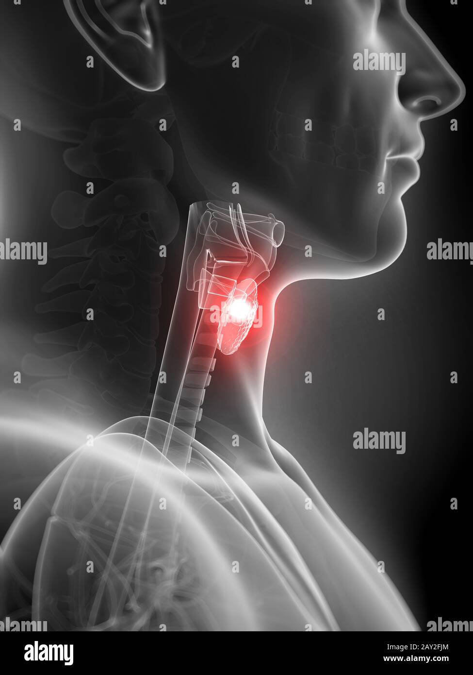 Rendu 3d illustration de l'inflammation de la glande thyroïde Banque D'Images