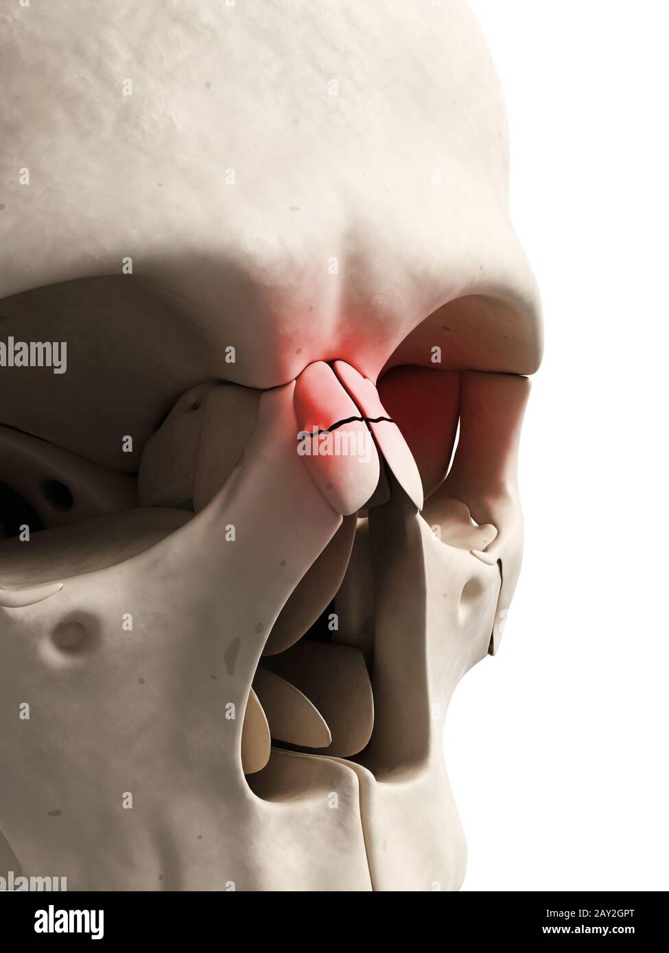 Illustration médicale d'un nez cassé Banque D'Images
