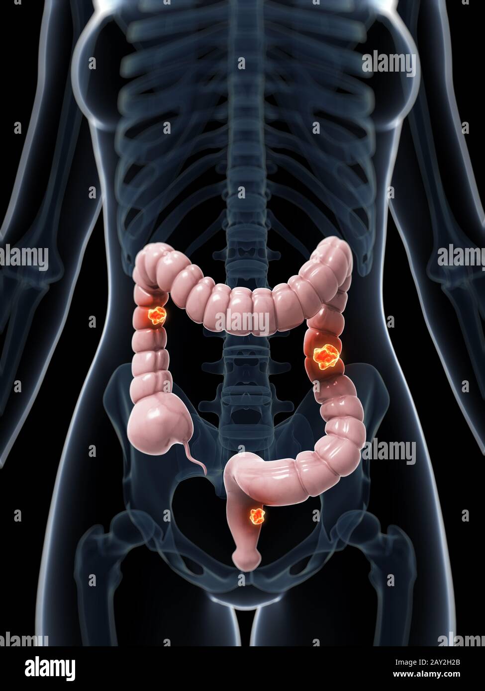 Rendu 3d illustration de cancer du colon Banque D'Images