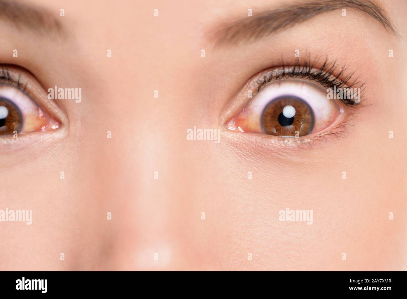 œil Injecte De Sang Yeux Banque D Image Et Photos Alamy
