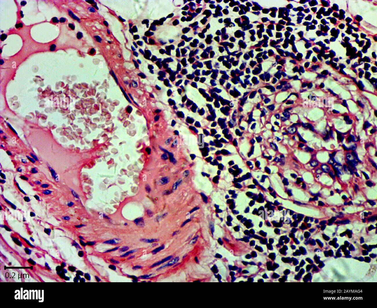 coupe histologique de tissu de cancer gastrique, 2000 x Banque D'Images